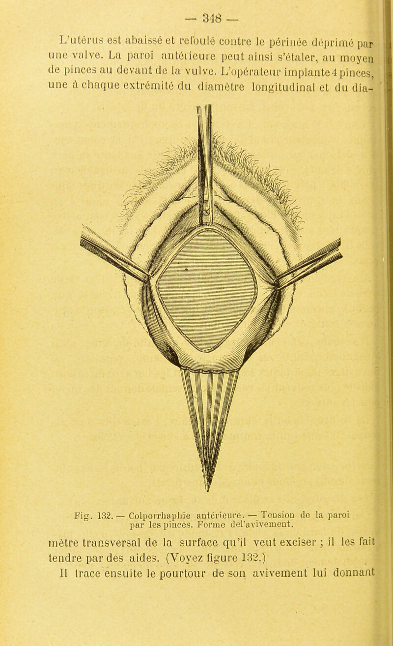 L'utérus est abaissé et rclbulé contre le périnée déprimé par une valve. La paroi antéiicurc peut ainsi s'étaler, au moyen (le pinces au devant de la vulve. L'opérateur implante4 pinces, une cl chaque extrémité du diamètre longitudinal et du dia- ' Fig. 132. — ColpoiTliaphie antérieure. — Tcusioa do la paroi par les pinces. Forme deravivemcut. mètre transversal de la surface qu'il veut exciser ; il les fait tendre par des aides. (Voyez figure 132.) Il trace ensuite le pourtour de son avivement lui donnant