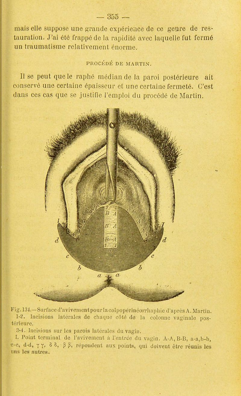 mais elle suppose une gmiicle expérience de ce genre de res- tauration. J'ai été frappé de la rapidité avec laquelle fut fermé un traumatisme relativement énorme. PnOCÉDÉ DE MARTIN. Il se peut que le raphé médian de la paroi postérieure ait conservé une certaine épaisseur et une certaine fermeté. C'est dans ces cas que se justifie l'emploi du procédé de Martin. Fig. 13i.—Surface d'avîvementpourlacolpopérincorrhapliie d'après A. Martiu. 1-2. Incisions latérales dé chaque côte de la colonne vaginale pos- térieure. 3'4. Incisions sur les parois latérales du vagin. I. Point terminal de l'avivement à l'entrée du vagin. A-A,B-B, a-a,b-b, c-c, d-d, Y Y, S 0, p p; répondent aux points, qui doivent être réunis les uns les autres.