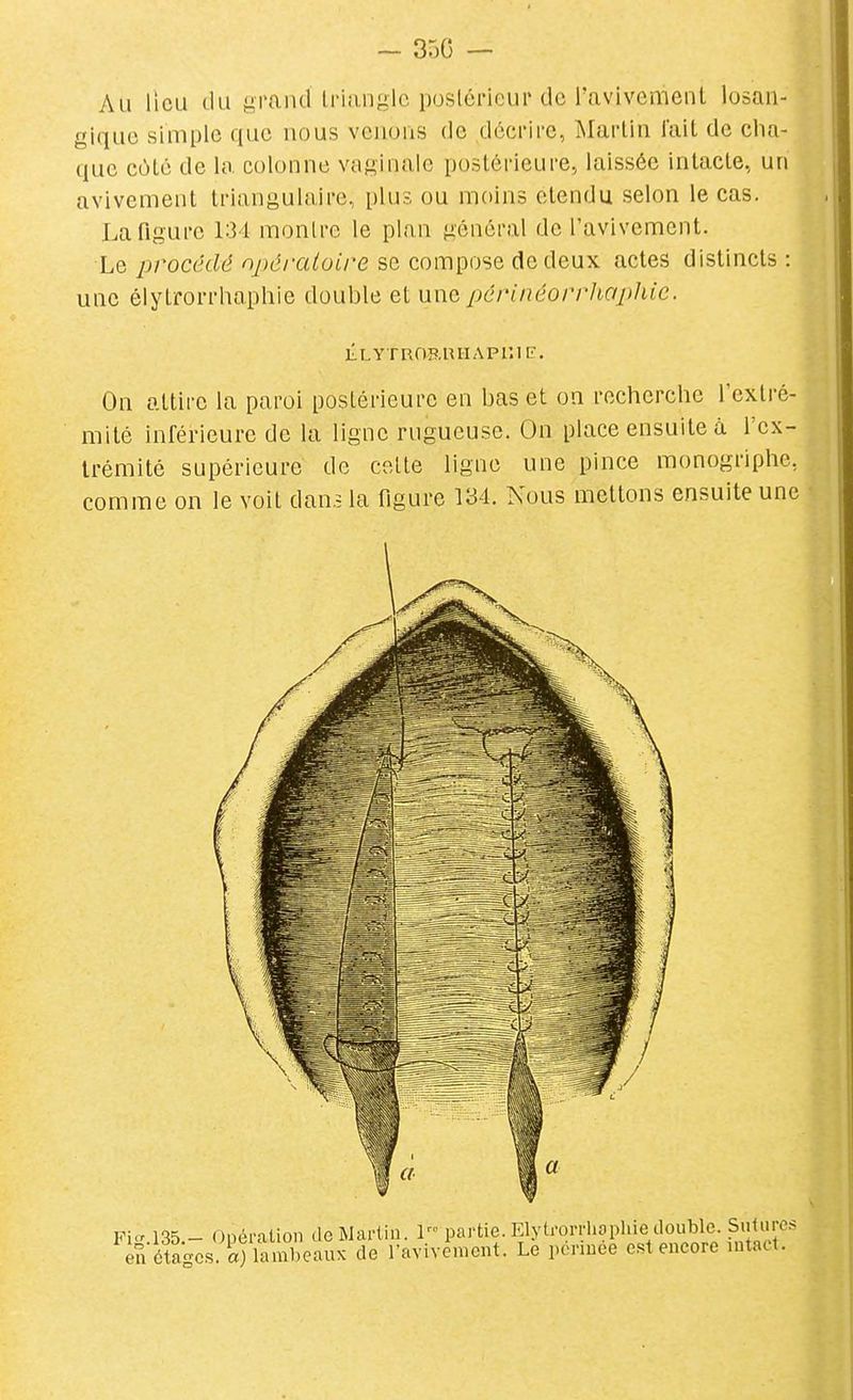Au lieu du grand triangle postérieur de i'avivement losan- gique simple que nous venons de décrire, Martin l'ait de cha- que côté de la colonne vaginale postérieure, laissée intacte, un avivement triangulaire, plus ou moins étendu selon le cas, La figure 134 montre le plan général de I'avivement. Le ;jromfô oy;J/'a^oire se compose de deux actes distincts: une élytrorrhaphie double et wwq, pcrinéorrhaphic. L-LYTROB-IU-IAPUIE. On attire la paroi postérieure en bas et on recherche l'extré- mité inférieure de la ligne rugueuse. On place ensuite à l'ex- trémité supérieure de colle ligne une pince raonogriphe, comme on le voit dans la figure 134. Nous mettons ensuite une 135.- Onéralion de Martin. 1 partie. Elytrorrhophie double. Suture- étascs. S) lambeaux de Tavivement. Le pcriuee est encore intact. Fig en étages, a)