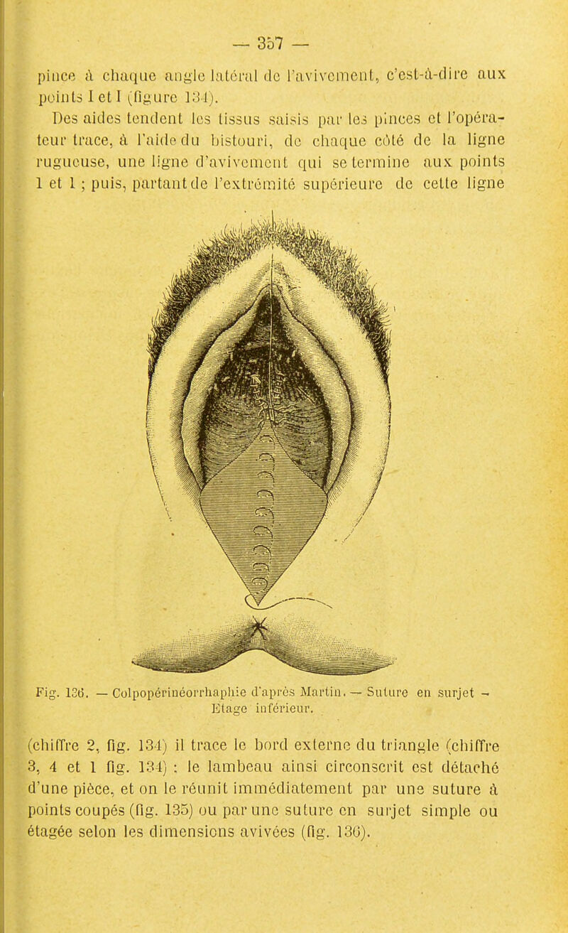 pince à chaque angle latéral de ravivcment, c'cst-ù-clire aux points 1 et I (figure Des aides tendent les tissus saisis par les pinces et l'opéra- teur trace, à l'aide du bistouri, de chaque côté de la ligne rugueuse, une ligne d'avivemcnt qui se termine aux points 1 et 1 ; puis, partant de l'extrémité supérieure de cette ligne Fig. lotî. — Colpopérinéorrliapliie d'après Martin. — Suture en surjet - Etage inférieur. (chiffre 2, fig. 134) il trace le bord externe du triangle (chiffre 3, 4 et 1 fig. 134) : le lambeau ainsi circonscrit est détaché d'une pièce, et on le réunit immédiatement par une suture à points coupés (fig. 135) ou par une suture en surjet simple ou étagée selon les dimensions avivées (fig. 13G).