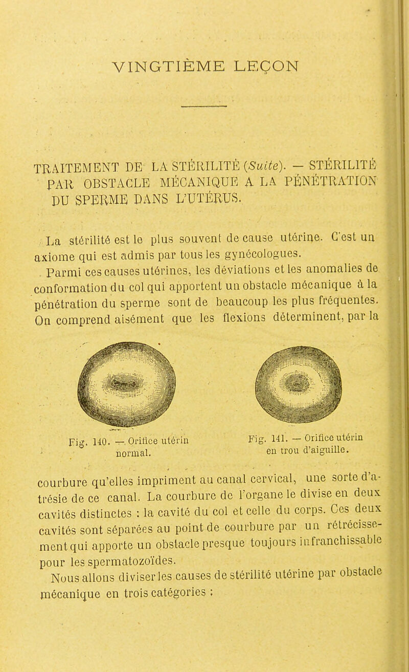 VINGTIÈME LEÇON TRAITEMENT DE LA STÉRILITÉ {Suite). - STÉRILITÉ PAR OBSTACLE MÉCANIQUE A LA PÉNÉTRATION DU SPERME DANS L'UTÉRUS. La stérilité est le plus souvent de cause utérine. C'est un axiome qui est admis par tous les gynécologues. . Parnii ces causes utérines, les déviations elles anomalies de conformation du col qui apportent un obstacle mécanique à la pénétration du sperme sont de beaucoup les plus Fréquentes. On comprend aisément que les flexions déterminent, par la courbure qu'elles impriment au canal cervical, une sorte d'a- trésie de ce canal. La courbure de l'organe le divise en deux cavités distinctes : la cavité du col et celle du corps. Ces deux cavités sont séparées au point de courbure par un rétrécisse- ment qui apporte un obstacle presque toujours infranchissable pour les spermatozoïdes. Nous allons diviser les causes de stérilité utérine par obstacle mécanique en trois catégories : Fig. HO. — Orifice utérin normal. Fig. 141. — Orifice utérin en trou d'aiguille.