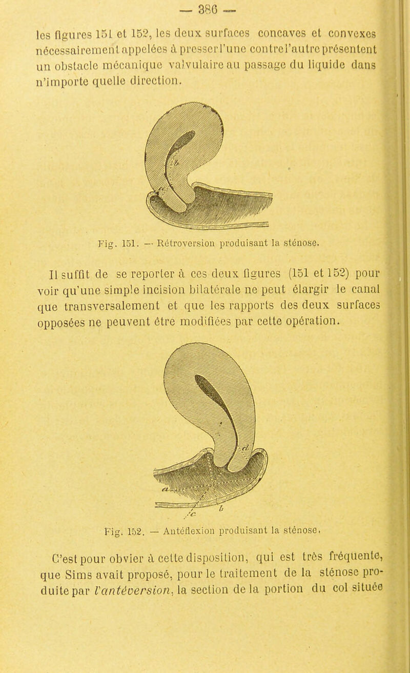 — 380 — les figures 151 et 152, les deux surfaces concaves et convexes nécessairement appelées à presserl'une contrel'autre présentent un obstacle mécanique valvulaireau passage du liquide dans n'importe quelle direction. Fig. 151. — Rétroversion produisaut la sténose. Il suffit de se reporter à ces deux ûgures (151 et 152) pour voir qu'une simple incision bilatérale ne peut élargir le canal que transversalement et que les rapports des deux surfaces opposées ne peuvent être modifiées par cette opération. Fig. 152. — Autéflexion produisant la sténose. C'est pour obvier à cette disposition, qui est très fréquente, que Sims avait proposé, pour le traitement de la sténose pro- duite par Vcintéoersion, la section de la portion du col située