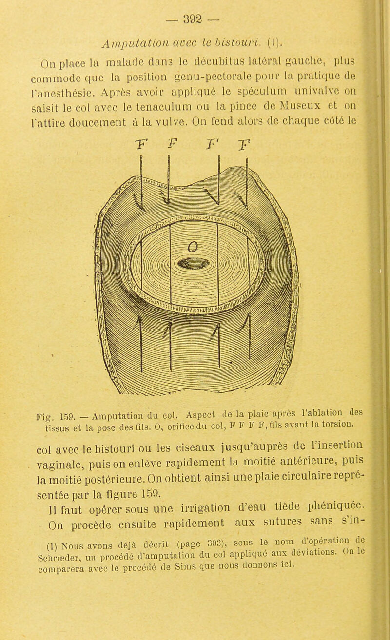 Amputation avec le bistouri. (1). On place la malade dans le dôcubilus latéral gauche, plus commode que la posilioii genu-peclorale pour la pratique de l'anesthésie. Après avoir appliqué le spéculum univalve on saisit le col avec le tenaculum ou la pince de Museux et on l'attire doucement à la vulve. On fend alors de chaque côté le Fio- 159. — Amputation du col. Aspect de la plaie après l'ablation des tissus et la pose des fils. 0, oridce du col, F F F F, fils avant la torsion. col avec le bistouri ou les ciseaux jusqu'auprès de l'insertion vaginale, puis on enlève rapidement la moitié antérieure, puis la moitié postérieure. On obtient ainsi une plaie circulaire repré- sentée par la figure 159, Il faut opérer sous une irrigation d'eau tiède phéniquée. On procède ensuite rapidement aux sutures sans s'in-. (1) Nous avons déjà décrit (page 303), sous le nom d;opération de Schrœder, un procédé d'amputation du col appliqué aux déviations. On le comparera avec le procédé de Sims que nous donnons ici.