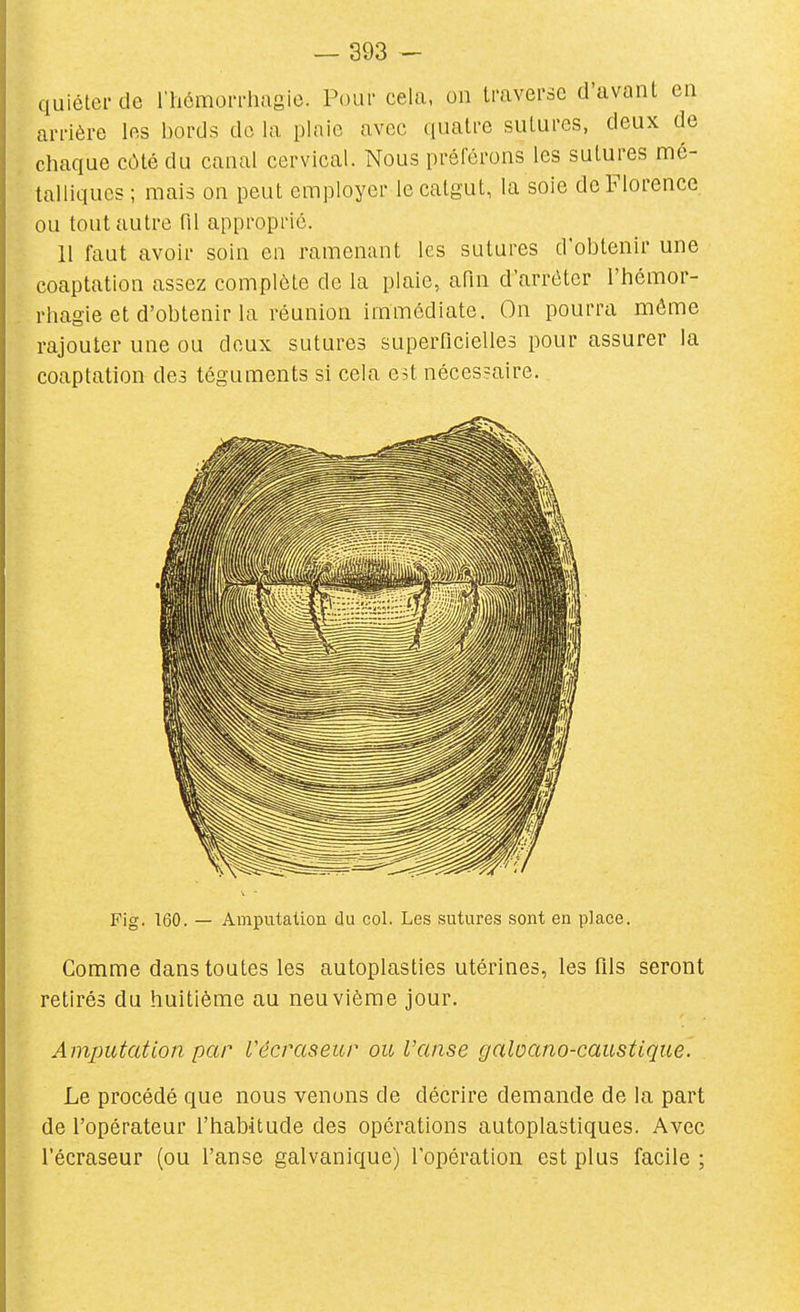 quiétei- de riiémorrhagie. Pour cela, on traverse d'avant en arrière les bords do la plaie avec quatre sutures, deux de chaque côté du canal cervical. Nous préférons les sutures mé- talliques ; mais on peut employer le catgut, la soie de Florence ou tout autre fil approprié. 11 faut avoir soin en ramenant les sutures d'obtenir une coaptation assez complète de la plaie, afin d'arrêter l'hémor- rhagie et d'obtenir la réunion immédiate. On pourra môme rajouter une ou deux sutures superficielles pour assurer la coaptation des téguments si cela est nécessaire. Fig. 160. — Amputation du col. Les sutures sont en place. Comme dans toutes les autoplasties utérines, les fils seront retirés du huitième au neuvième jour. Amputation par Vécraseur ou l'anse galoano-caustique. Le procédé que nous venons de décrire demande de la part de l'opérateur l'habitude des opérations autoplastiques. Avec l'écraseur (ou l'anse galvanique) l'opération est plus facile ;