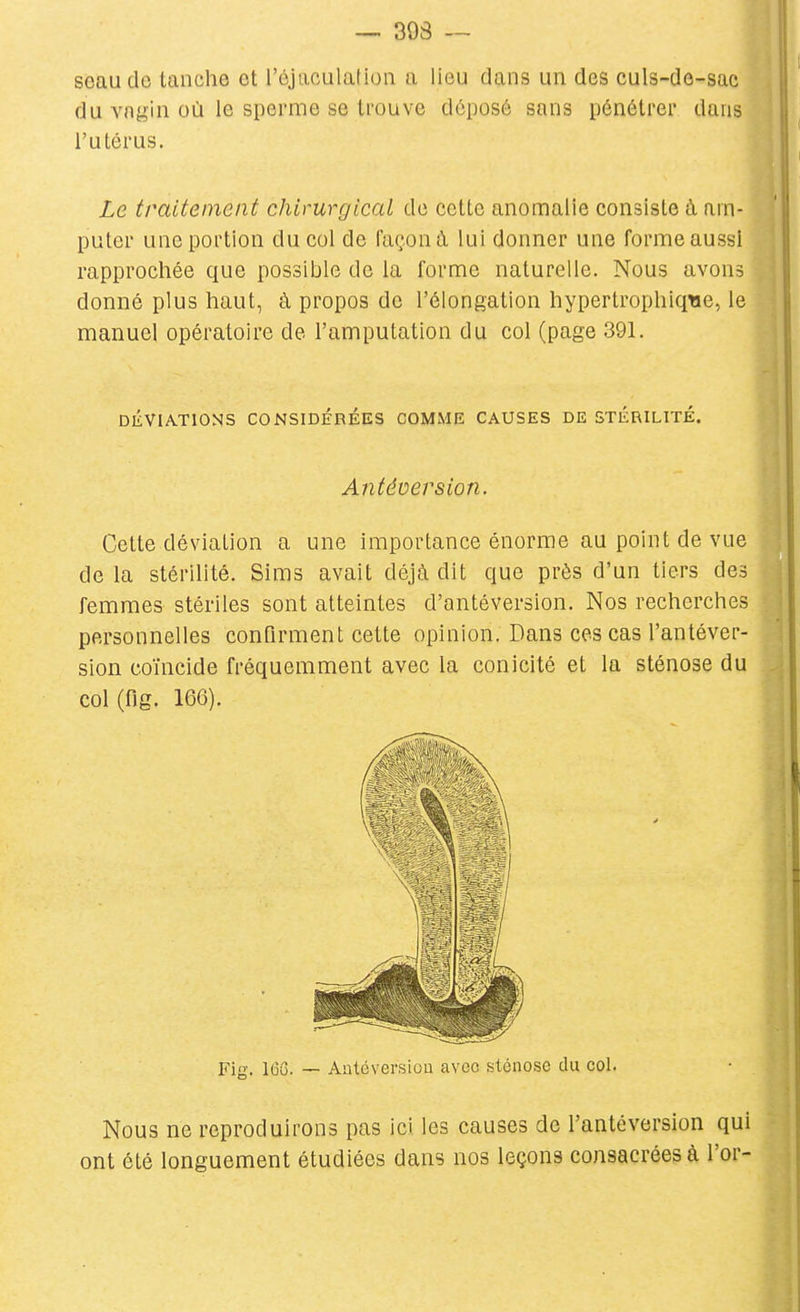 seau de tanche et l'éjaculatioii a lieu dans un des culs-de-sac du vngin où le sperme se trouve dôposô sans pénétrer dans l'utérus. Le traitement chirurgical de cette anomalie consiste à am- puter une portion du col de façon à lui donner une forme aussi rapprochée que possible de la forme naturelle. Nous avons donné plus haut, à propos de l'élongation hypertrophiqtie, le manuel opératoire de l'amputation du col (page 391. DÉVIATIONS CONSIDÉRÉES COMME CAUSES DE STÉRILITÉ. Cette déviation a une importance énorme au point de vue de la stérilité. Sims avait déjà dit que près d'un tiers des femmes stériles sont atteintes d'antéversion. Nos recherches personnelles confirment cette opinion. Dans ces cas l'antéver- sion coïncide fréquemment avec la conicité et la sténose du col(ng. 166). Nous ne reproduirons pas ici les causes de l'antéversion qui ont été longuement étudiées dans nos leçons consacrées à l'or- Antéversion. Fig. 166. Aatéversiou avec sténose du col.