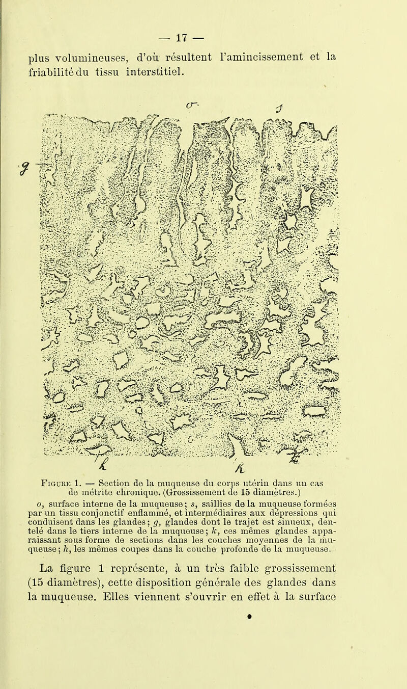 plus volumineuses, d'où résultent l'amincissement et la friabilité du tissu interstitiel. FiGUKE 1. — Section de la muquouso du corps utérin dans un cas de méti'ite chronique. (Grossissement de 15 diamètres.) o, surface interne de la muqueuse; s, saillies delà muqueuse formées par un tissu conjonctif enflammé, et intermédiaires aux dépressions qui conduisent dans les glandes; g, glandes dont le trajet est sinueux, den- telé dans le tiers interne de la muqueuse; k, ces mêmes glandes appa- raissant sous forme de sections dans les couclies moyennes de la mu- queuse; h, les mêmes coupes dans la couche profonde de la muqueuse. La figure 1 représente, à un très faible grossissement (15 diamètres), cette disposition générale des glandes dans la muqueuse. Elles viennent s'ouvrir en etfet à la surface