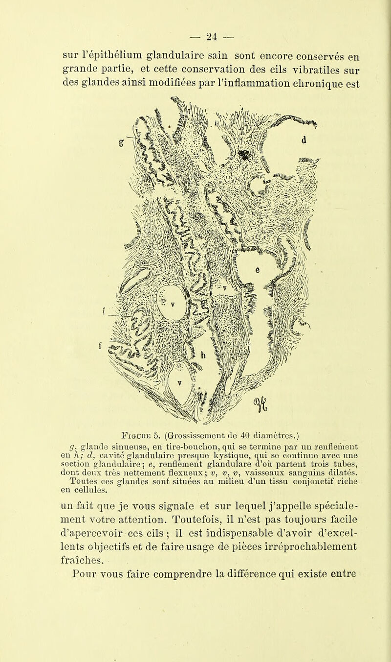 sur l'épithélium glandulaire sain sont encore conservés en grande partie, et cette conservation des cils vibratiles sur des glandes ainsi modifiées par l'inflammation chronique est FiauiiE 5. (Grossissement de 40 diamètres.) g, glande sinueuse, en tire-bonchon, qui se termine par un ronflement en A; d, cavité glandulaire presque kystique, qui se continue avec une section glandulaire; e, renflement glandulare d'où partent trois tubes, dont deux très nettement flexueux; v, v, vaisseaux sanguius dilatés. Toutes ces glandes sont situées au milieu d'un tissu conjonctif riche en cellules. un fait que je vous signale et sur lequel j'appelle spéciale- ment votre attention. Toutefois, il n'est pas toujours facile d'apercevoir ces cils ; il est indispensable d'avoir d'excel- lents objectifs et de faire usage de pièces irréprochablement fraîches. Pour vous faire comprendre la différence qui existe entre