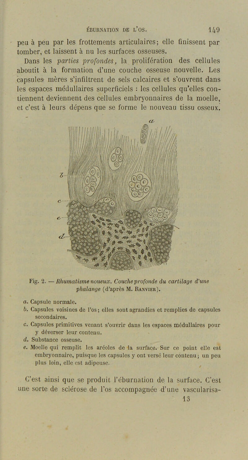 ÉBURNATION DE l’oS. 1/j9 peu à peu par les frottements articulaires; elle finissent par tomber, et laissent à nu les surfaces osseuses. Dans les parties profondes, la prolifération des cellules aboutit à la formation d’une couche osseuse nouvelle. Les capsules mères s’infiltrent de sels calcaires et s’ouvrent dans les espaces médullaires superficiels : les cellules qu’elles con- tiennent deviennent des cellules embryonnaires de la moelle, et c’est à leurs dépens que se forme le nouveau tissu osseux. Fig. 2. —Rhumatisme noueux. Couchejtrofonde du cartilage d’une phalange (d’après M. Ranvier). a. Capsule normale. b. Capsules voisines de l’os; elles sont agrandies et remplies de capsules secondaires. c. Capsules primitives venant s’ouvrir dans les espaces médullaires pour y déverser leur contenu. d. Substance osseuse. e. Moelle qui remplit les aréoles de la surface. Sur ce point elle est embryonnaire, puisque les capsules y ont versé leur contenu ; un peu plus loin, elle est adipeuse. C’est ainsi que se produit l’éburnation de la surface. C’est une sorte de sclérose de l’os accompagnée d’une vascularisa-