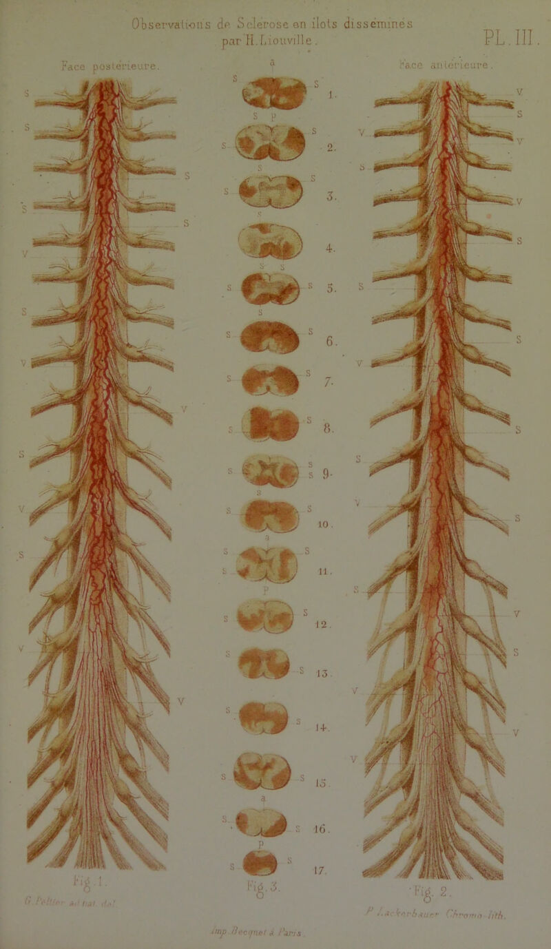 ObservaUoiis df' Sclérose an ilols disséminés par H.f. iouville. PL. III. Face posterieure. (l f'i'tl’r-r ir 1,^1 f/,.' tmji /ii'crjncl J /'jrjs