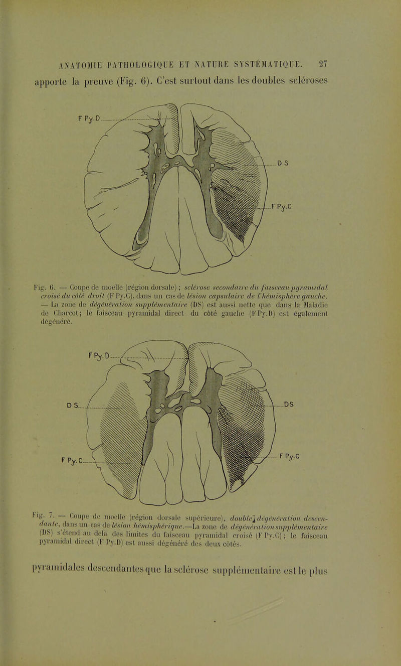 apporte la preuve (Fig. 6). C'est siirloiit dans les doubles scléroses (5. — Coupe de moelle (région dorsiile) ; sclcro>>c aecoiulairc du fdiuccaKpyraiiiuldl croisé ilu côté droit (F l'y.C), dans un cas de Lésion capsiilairc de l'/iéinisphcrc gaitchc. — La zone de dégénéra lion supplémentaire (DS) est aussi nel.te que dans la Maladie de Cliarcot; le faisceau pyramidal dii'ecl. du côté gauche (l'Ty.D) est égaiemenl dégénéré. pyramidal direct [V Py.D) est aussi dégénéré des dcu.\ côtés pyraitiidales desceudanlesque la sclérose suppléuieulaire esLle [)lus