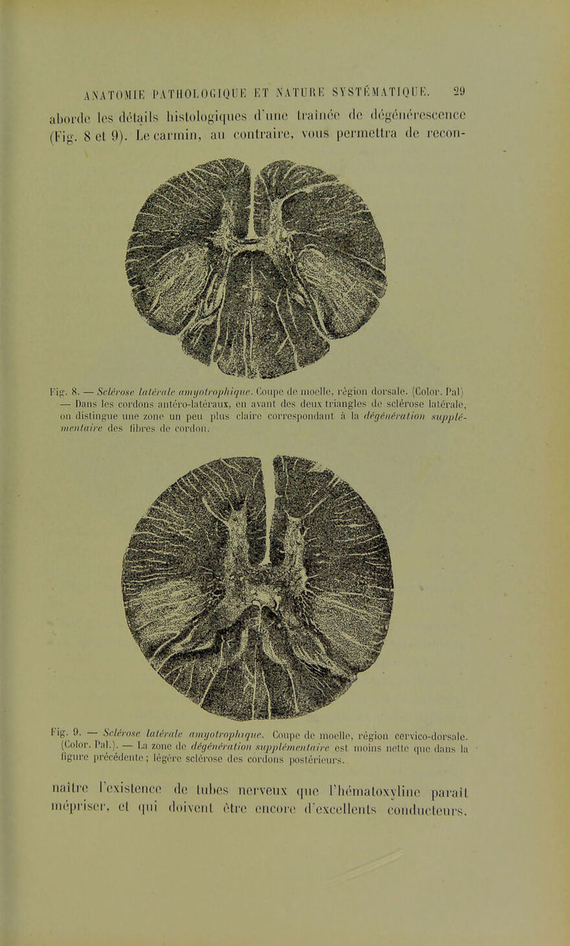 aborde les détails liislologiqiies (rime Lraiiiée de dégénérescence (Fig. 8 et 9). Le carmin, au contraire, vous permettra de rccon- Fi;ï. 8. — Sclérose laléralr ann/olrop/iicjiw. Coupe de moelle, région dorsale. (Color. Pal) — Dans les cordons antéro-laléraux, en avanl des deux triangles de sclérose laléralc, on dislingue une zone un peu plus claire correspondant à la dégéiiévation supplé- vienlaire des libres de cordon. Fig. 9. — Sclérose laléralc amyoiroplnqae. Coupe de moelle, l'égion ccrvico-dorsale. (Color. l'ai.). — La zone de dégénérulion supplômciUairc est moins nelle (pic dans la figure précédente; légère sclérose des cordons postérieurs. naître l'existence de tubes nerveux qne l'bématoxyline parait mépriser, et ([ui doivent être encore dcxcellents conducteurs.