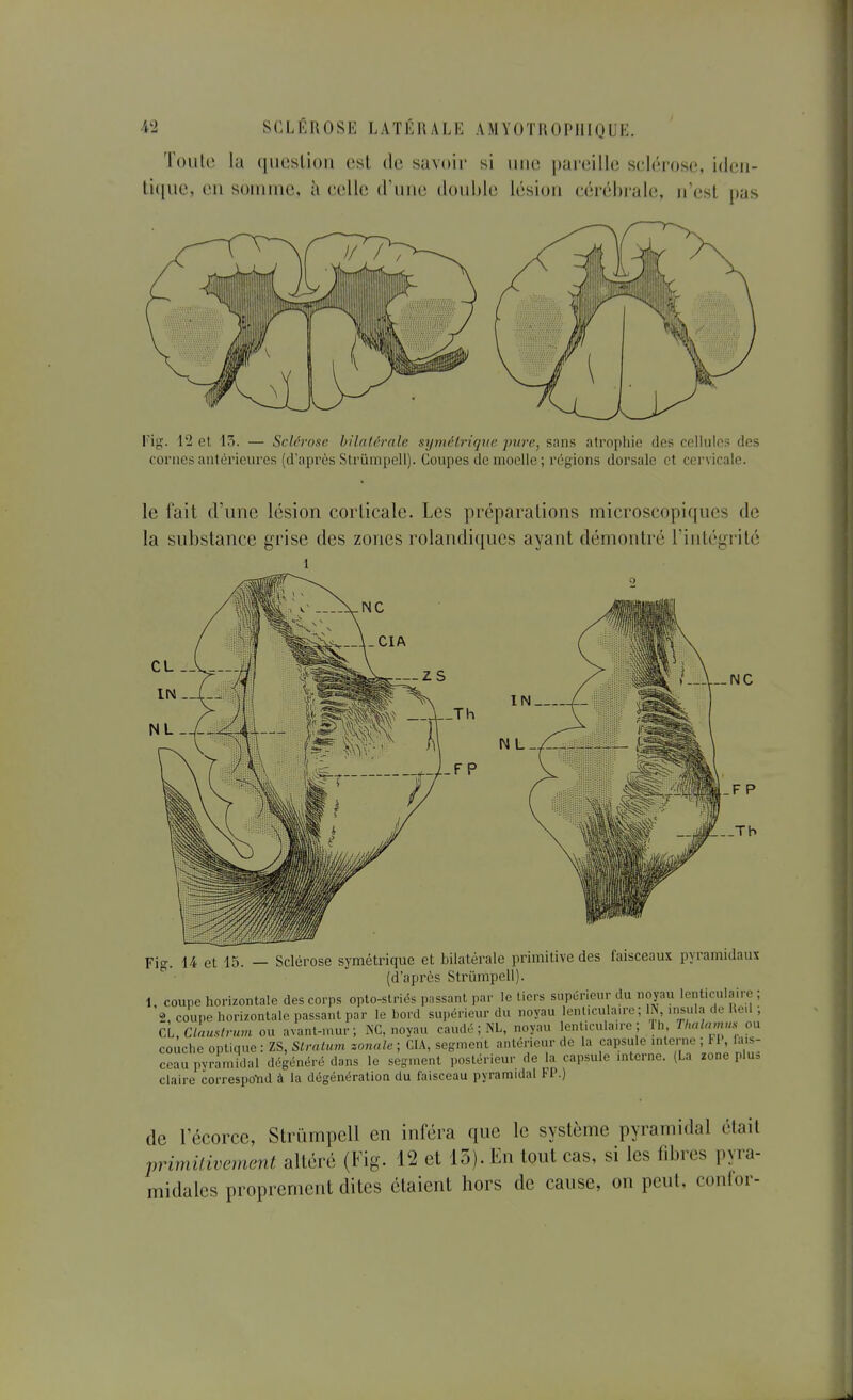 Toute la qiiesliou esl de savoir si iiiie pareille sclérose, ideii- li([ue, eu soinine, à celle d'une double lésion cérébrale, n'est pas rig. 12 et. 15. — Sclérose h'ialérnle symétrique pure, sans atrophie des cellules des cornes antérieures (d'après Strumpell). Coupes de moelle ; régions dorsale et cervicale. le fait d'une lésion corticale. Les préparations microscopiques de la substance grise des zones rolandiques ayant démontré l'intégrité 1 — zs —J\—Th IN__ N L f-/-FP Fig. 14 et 15. — Sclérose symétrique et bilatérale primitive des faisceaux pyramidaux (d'après Strumpell). 1. coupe horizontale des corps opto-striés passant par le tiers supérieur du noyau lenticulaire ; 2, coupe horizontale passant par le bord supérieur du noyau lenl.culaue; IN insuln de lle.l ; CL^CLnustrnvi ou avant-mur; ISC, noyau caudr ; NL, noyau lenliculau-e ; ih TUalunu,. ou couche optique : ZS, Slrntum zonnle ; CIA, segment antérieur de la capsule mterne ; Fl la s- ceau pyramidal dégénéré dans le segment postérieur de la capsule mtcrnc. (La zone plu= claire correspoYid à la dégénération du faisceau pyramidal FP.) de l'écorce, Strumpell en inféra que le système pyramidal était primilivement altéré (Fig. 12 et 15). En tout cas, si les fibres pyra- midales proprement dites étaient hors de cause, on peut, confor-