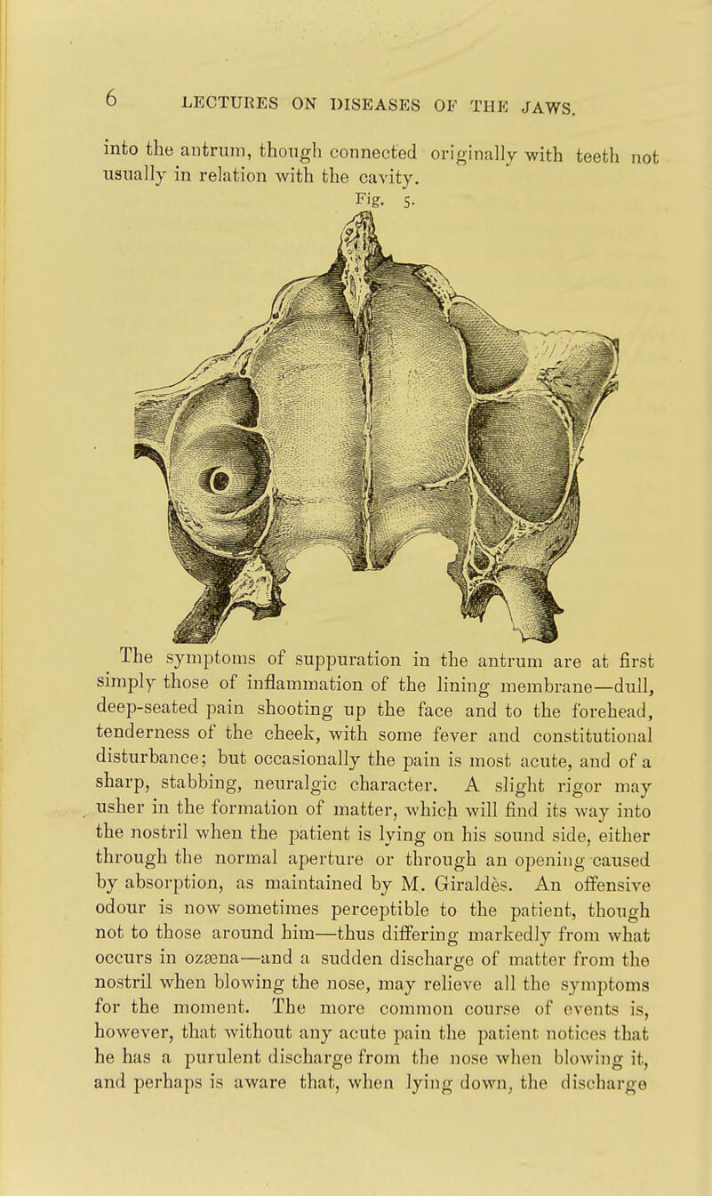 into the antrum, though connected originallj with teeth not usually in relation with the cavity. Fig. 5- The symptoms of suppuration in the antrum are at first simply those of inflammation of the lining membrane—dull, deep-seated pain shooting up the face and to the forehead, tenderness of the cheek, with some fever and constitutional disturbance; but occasionally the pain is most acute, and of a sharp, stabbing, neuralgic character. A slight rigor may usher in the formation of matter, which will find its way into the nostril when the patient is lying on his sound side, either through the normal aperture or through an opening caused by absorption, as maintained by M. Giraldes. An offensive odour is now sometimes perceptible to the patient, though not to those around him—thus differing markedly from what occurs in ozsena—and a sudden discharge of matter from the nostril when blowing the nose, may relieve all the symptoms for the moment. The more common course of events is, however, that without any acute pain the patient notices that he has a purulent discharge from the nose when blowing it, and perhaps is aware that, when lying down, the discharge