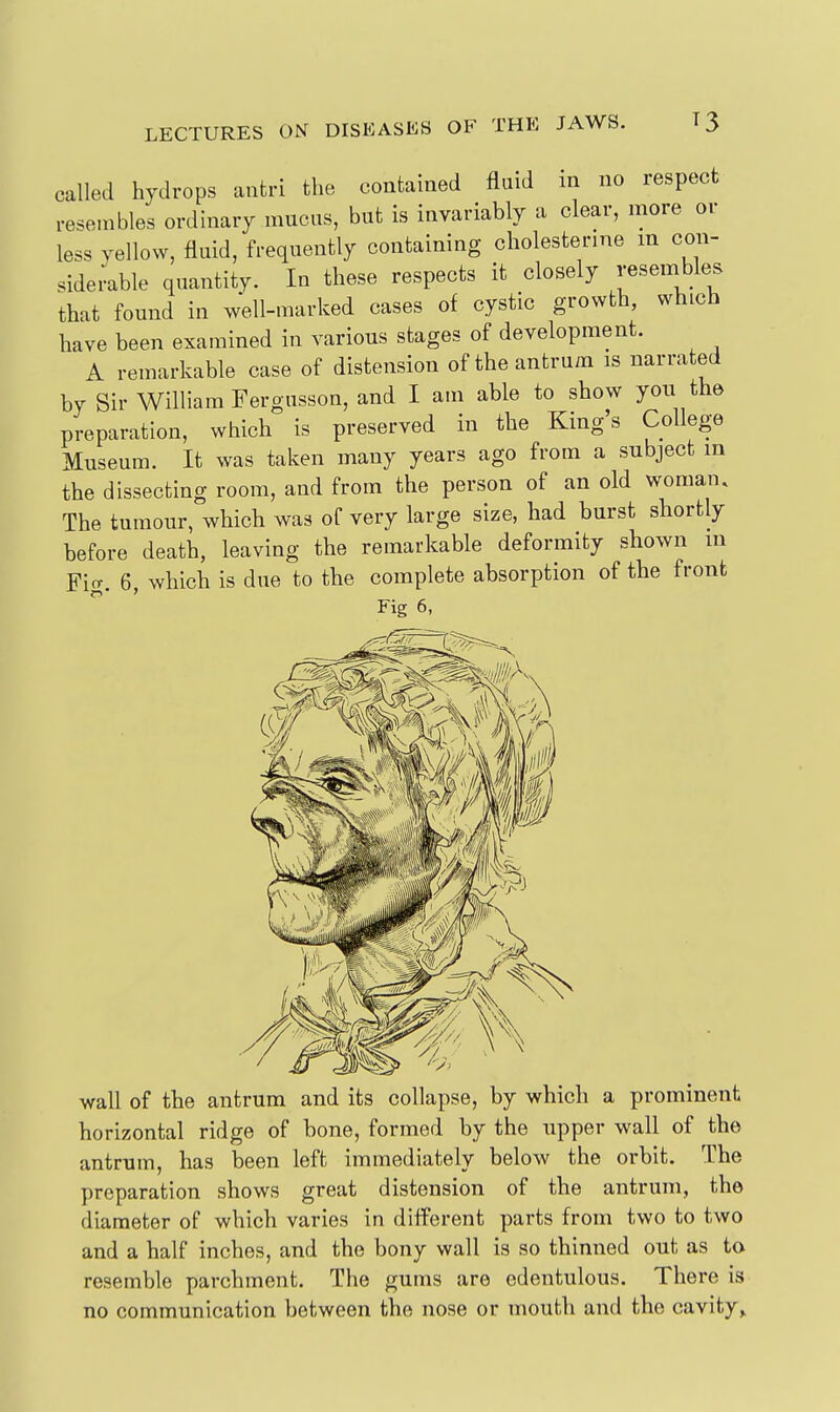 called hydrops antri the contained fluid in no respect resembles ordinary mucus, but is invariably a clear, more or less yellow, fluid, frequently containing cholesterme m con- siderable quantity. In these respects it closely ^-esembles that found in well-marked cases of cystic growth, which have been examined in various stages of development. A remarkable case of distension of the antrum is narrated by Sir William Fergusson, and I am able to show you the preparation, which is preserved in the King's College Museum. It was taken many years ago from a subject in the dissecting room, and from the person of an old woman. The tumour, which was of very large size, had burst shortly before death, leaving the remarkable deformity shown m Fig. 6, which is due to the complete absorption of the front Fig 6, wall of the antrum and its collapse, by which a prominent horizontal ridge of bone, formed by the upper wall of the antrum, has been left immediately below the orbit. The preparation shows great distension of the antrum, the diameter of which varies in different parts from two to two and a half inches, and the bony wall is so thinned out as to resemble parchment. The gums are edentulous. There is no communication between the nose or mouth and the cavity^