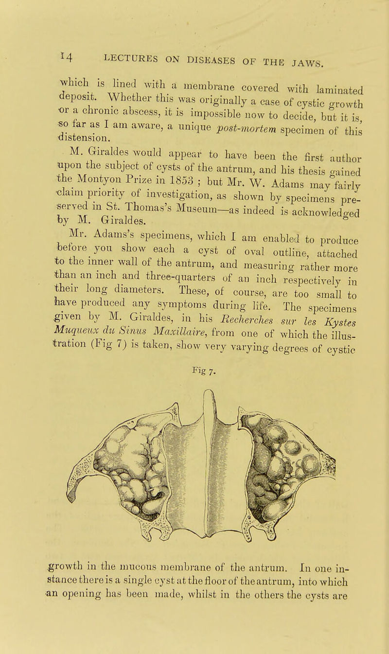 Which IS hned with a membrane covered with laminated deposit. Whether this was originallj a case of cystic growth or a chronic abscess, it is impossible now to decide, but it is so tar as I am aware, a unique post-mortem specimen of this distension. M. Giraldes would appear to have been the first author upon the subject of cysts of the antrum, and his thesis gained the Montyon Prize in 1853 ; but Mr. W. Adams may fairly <3laim priority of investigation, as shown by specimens pre- served m St. Thomas's Museum-as indeed is acknowledged by M. Griraldes. ^ Mr. Adams's specimens, which I am enabled to produce before you show each a cyst of oval outline, attached to the inner wall of the antrum, and measuring rather more than an mch and three-quarters of an inch respectively in their long diameters. These, of course, are too small to have produced any symptoms during life. The specimens ^iven by M. Giraldes, in his Eecherches sur les Kystes Mtiqueux du Sinus Maxillaire, from one of which the illus- tration (Fig 7) is taken, show very varying degrees of cystic Fig 7. growth in the mucous membrane of the antrum. In one in- stance there is a single cyst at the floor of the antrum, into which •an opening has been made, whilst in the others the cysts are