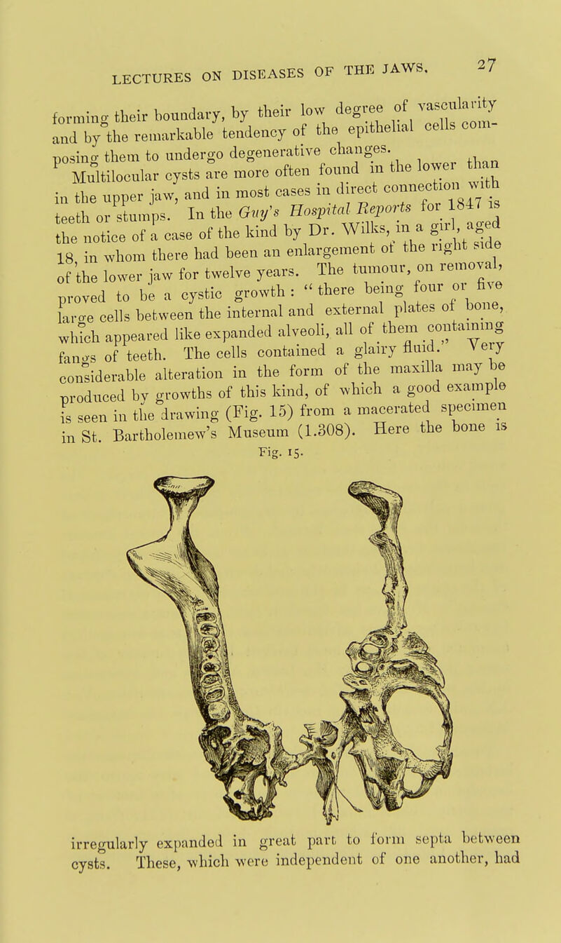 formincr their boundary, by their low degree of vascukuty Jd by^the re,narkable tendency of the epithehal cells com- posino- them to undergo degenerative changes. ^ Multilocular cysts are more often found m the lower than in'he upper jaw'and in most cases in direct connechon -th teeth or stumps. In the Grn/s ^^-F^f^^^^^^-^^ / fo-ed the notice of a case of the kind by Dr. Wilks m a gul aged 18 in whom there had been an enlargement ot the right side of'the lower jaw for twelve years. The tumour on remova^ proved to be a cystic growth : ^ there being four oi fi^ e L-e cells between the internal and external plates of bone, wh^h appeared like expanded alveoli, all of them containing fanos of teeth. The cells contained a glairy fluid. Ve y considerable alteration in the form of the maxilla may be produced bv growths of this kind, of which a good example is seen in the drawing (Fig. 15) from a macerated specimen in St. Bartholemew's Museum (1.308). Here the bone is Fig. 15- irrefrularly exi)anded in great part to form septa between cysts. These, which were independent of one another, had