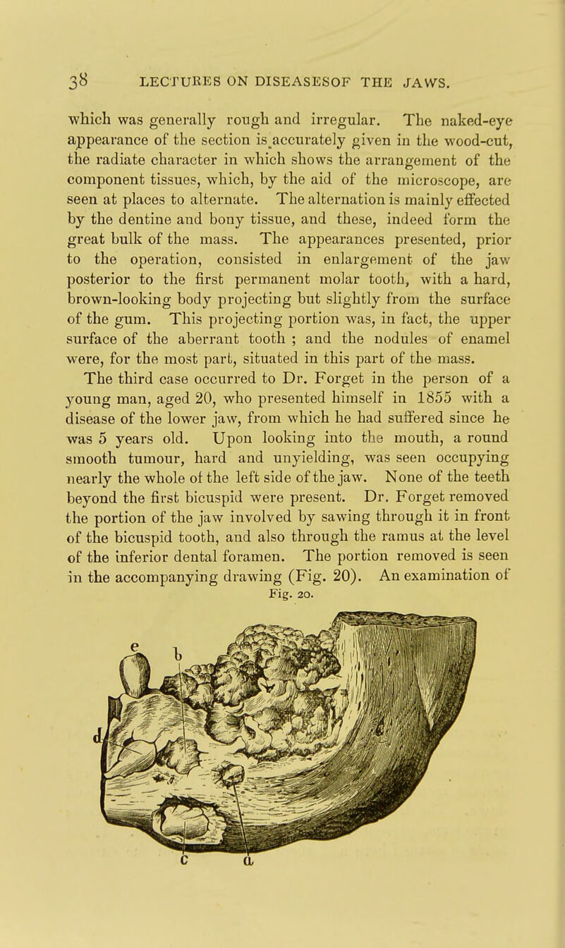 ■which was generally rough and irregular. The naked-eye appearance of the section is accurately given in the wood-cut, the radiate character in which shows the arrangement of the component tissues, which, by the aid of the microscope, are seen at places to alternate. The alternation is mainly effected by the dentine and bony tissue, and these, indeed form the great bulk of the mass. The appearances presented, prior to the operation, consisted in enlargement of the jaw posterior to the first permanent molar tooth, with a hard, brown-looking body projecting but slightly from the surface of the gum. This projecting portion was, in fact, the upper surface of the aberrant tooth ; and the nodules of enamel were, for the most part, situated in this part of the mass. The third case occurred to Dr. Forget in the person of a young man, aged 20, who presented himself in 1855 with a disease of the lower jaw, from which he had suffered since he was 5 years old. Upon looking into the mouth, a round smooth tumour, hard and unyielding, was seen occupying nearly the whole of the left side of the jaw. None of the teeth beyond the first bicuspid were present. Dr. Forget removed the portion of the jaw involved by sawing through it in front of the bicuspid tooth, and also through the ramus at the level of the inferior dental foramen. The portion removed is seen in the accompanying drawing (Fig. 20). An examination of Fig. 20. c a