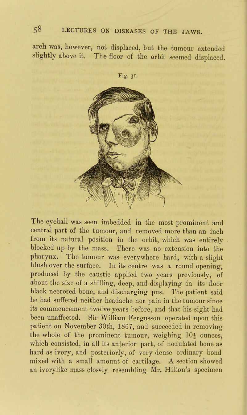 arch was, however, noi displaced, but the tumour extended slightly above it. The floor of the orbit seemed displaced. Fig. 3T. The eyeball was seen imbedded in the most prominent and central part of the tumour, and removed more than an inch from its natural position in the orbit, which was entirely blocked up by the mass. There was no extension into the pharynx. The tumour was everywhere hard, with a slight blush over the surface. In its centre was a round opening, produced by the caustic applied two years previously, of about the size of a shilling, deep, and displaying in its floor black necrosed bone, and discharging pus. The patient said he had suffered neither headache nor pain in the tumour since its commencement twelve years before, and that his sight had been unaffected. Sir William Fergasson operated upon this patient on November 30th, 1867, and succeeded in removing the whole of the prominent tumour, weighing 10^ ounces, which consisted, in all its anterior part, of nodulated bone as hard as ivory, and postei iorly, of very dense ordinary bond mixed with a small lunount of cartilage. A section showed an ivorylike mass closely resembling Mr. Hilton's specimen