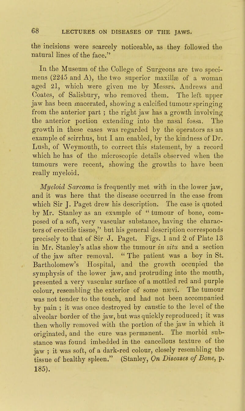 the incisions were scarcely noticeable, as they followed the natural lines of the face. In the Museum of the College of Surgeons are two speci- mens (2245 and A), the two superior maxillae of a woman aged 2l, which were given me by Messrs. Andrews and Coates, of Salisbury, who removed them. The left upper jaw has been macerated, showing a calcified tumour springing from the anterior part ; the right jaw has a growth involving the anterior portion extending into the nasal fossa. The growth in these cases was regarded by the operators as an example of scirrhus, but I am enabled, by the kindness of Dr. Lush, of Weymouth, to correct this statement, by a record which he has of the microscopic details observed when the tumours were recent, showing the growths to have been really myeloid. Myeloid Sarcoma is frequently met with in the lower jaw, and it was here that the disease occurred in the case from which Sir J. Paget drew his description. The case is quoted by Mr. Stanley as an example of  tumour of bone, com- posed of a soft, very vascular substance, having the charac- ters of erectile tissue, but his general description corresponds precisely to that of Sir J. Paget. Figs. 1 and 2 of Plate 13 in Mr. Stanley's atlas show the tumour in situ and a section of the jaw after removal.  The patient was a boy in St. Bartholomew's Hospital, and the growth occupied the symphysis of the lower jaw, and protruding into the mouth, presented a very vascular surface of a mottled red and purple colour, resembling the exterior of some nsevi. The tumour was not tender to the touch, and had not been accompanied by pain ; it was once destroyed by caustic to the level of the alveolar border of the jaw, but was quickly reproduced; it was then wholly removed with the portion of the jaw in which it originated, and the cure was permanent. The morbid sub- stance was found imbedded in the cancellous texture of the jaw ; it was soft, of a dark-red colour, closely resembling the tissue of healthy spleen. (Stanley, On Diseases of Bone, p. 185).