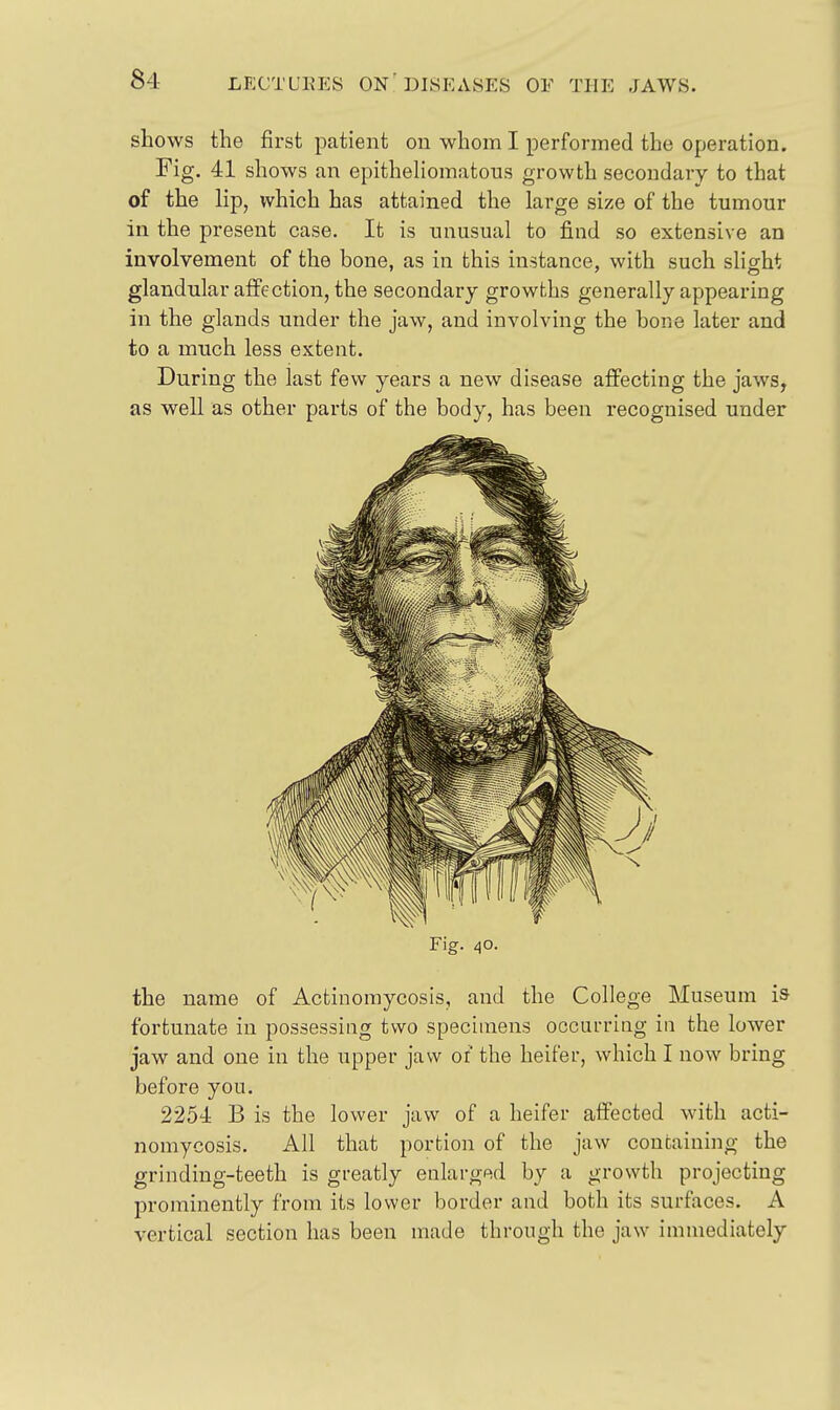 shows the first patient on whom I performed the operation. Fig, 41 shows an epithehomatous growth secondary to that of the lip, which has attained the large size of the tumour in the present case. It is unusual to find so extensive an involvement of the bone, as in this instance, with such sliofht glandular affection, the secondary growths generally appearing in the glands under the jaw, and involving the hone later and to a much less extent. During the last few years a new disease affecting the jaws, as well as other parts of the body, has been recognised under Fig. 40. the name of Actinomycosis, and the College Museum is fortunate in possessing two specimens occurring in the lower jaw and one in the upper jaw of the heifer, which I now bring before you. 2254 B is the lower jaw of a heifer affected with acti- nomycosis. All that portion of the jaw containing the grinding-teeth is greatly enlarged by a growth projecting prominently from its lower border and both its surfaces. A vertical section has been made through the jaw immediately