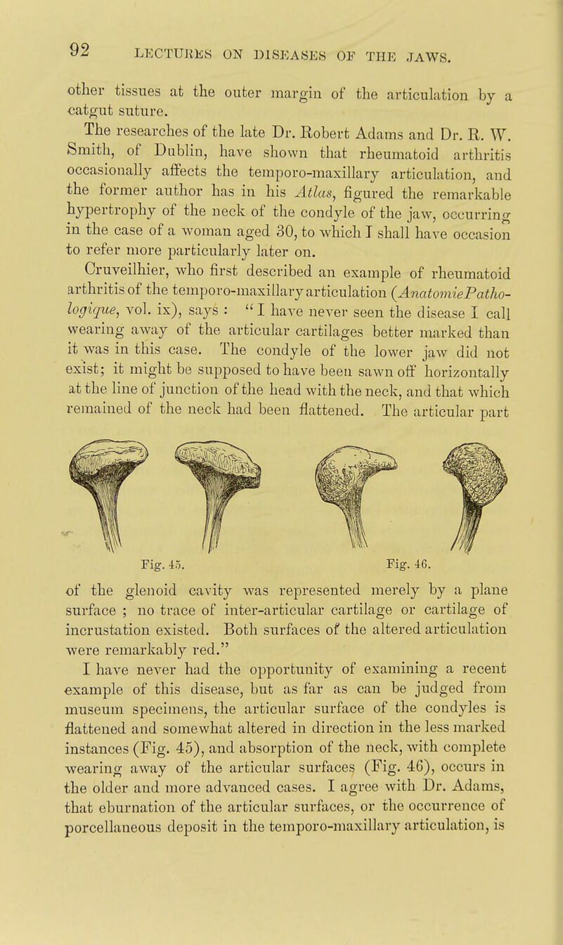 other tissues at the outer margin of the articulation by a catgut suture. The researches of the late Dr. Robert Adams and Dr. R. W. Smith, of Dublin, have shown that rheumatoid arthritis occasionally affects the temporo-maxillary articulation, and the former author has in his Atlas, figured the remarkable hypertrophy of the neck of the condyle of the jaw, occurring in the case of a woman aged 30, to which I shall have occasion to refer more particularly later on. Cruveilhier, who first described an example of rheumatoid arthritis of the temporo-maxillary articulation {AnatomiePatho- logique, vol. ix), says :  I have never seen the disease I call wearing away of the articular cartilages better marked than it was in this case. The condyle of the lower jaw did not exist; it might be supposed to have been sawn off horizontally at the line of junction of the head with the neck, and that which remained of the neck had been flattened. The articular part Fig. io. Fig. 46. of the glenoid cavity was represented merely by a plane surface ; no trace of inter-articular cartilage or cartilage of incrustation existed. Both surfaces of the altered articulation were remarkably red. I have never had the opporfcimity of examining a recent example of this disease, but as far as can be judged from museum specimens, the articular surface of the condyles is flattened and somewhat altered in direction in the less marked instances (Fig. 45), and absorption of the neck, with complete wearing away of the articular surfaces (Fig. 46), occurs in the older and more advanced cases. I agree with Dr. Adams, that eburnation of the articular surfaces, or the occurrence of porcellaneous deposit in the temporo-maxillary articulation, is