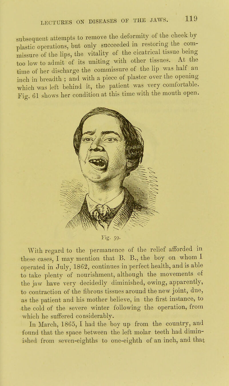 snb'^equent attempts to remove the deformity of the cheek by plastic operations, but only succeeded in restoring the com- missure of the lips, the vitality of the cicatrical tissue being too low to admit of its uniting with other tissues. At the time of her discharge the commissure of the lip was half an inch in breadth ; and with a piece of plaster over the opening which was left behind it, the patient was very comfortable. Fio-. 61 shows her condition at this time with the mouth open. Fig- 59- With regard to the permanence of the relief afforded in these cases, I may mention that B. B., the boy on whom I operated in July, 1862, continues in perfect health, and is able to take plenty of nourishment, although the movements of the jaw have very decidedly diminished, owing, apparently, to contraction of the iibrous tissues around the new joint, due, as the patient and his mother believe, in the first instance, to the cold of the severe winter following the operation, from which ho suffered considerably. In March, 1865, I had the boy up from the country, and found that the space between the left molar teeth had dimin- ished from seven-eighths to one-eighth of an inch, and that