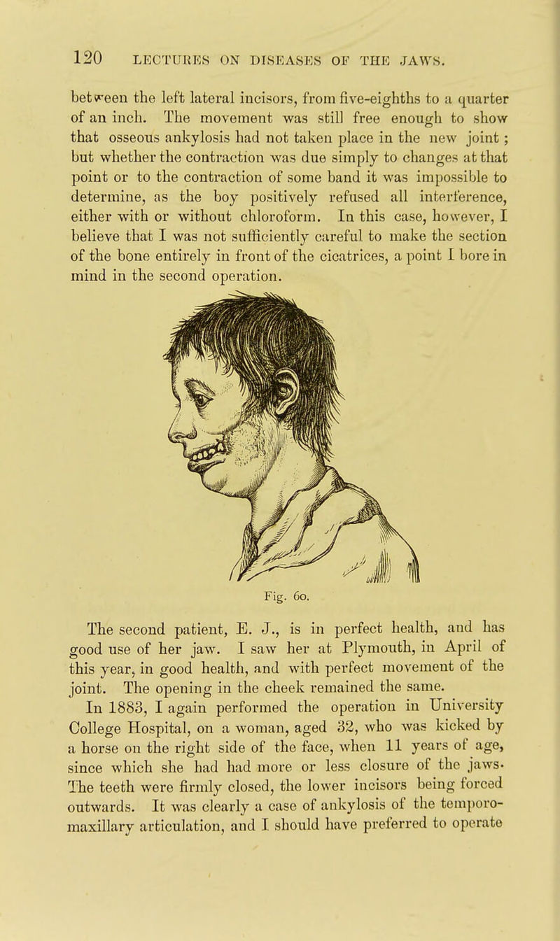 bet^reen the left lateral incisors, from five-eighths to a quarter of an inch. The movement was still free enough to show that osseous ankylosis had not taken place in the new joint; but whether the contraction was due simply to changes at that point or to the contraction of some band it was impossible to determine, as the boy positively refused all interference, either with or without chloroform. In this case, however, I believe that I was not sufficiently careful to make the section of the bone entirely in front of the cicatrices, a point I bore in mind in the second operation. Fig. 60, The second patient, E. J., is in perfect health, and has good use of her jaw. I saw her at Plymouth, in April of this year, in good health, and with perfect movement of the joint. The opening in the cheek remained the same. In 1883, I again performed the operation in University College Hospital, on a woman, aged 32, who was kicked by a horse on the right side of the face, when 11 years of age, since which she had had more or less closure of the jaws- The teeth were firmly closed, the lower incisors being forced outwards. It was clearly a case of ankylosis of the temporo- maxillary articulation, and I should have preferred to operate