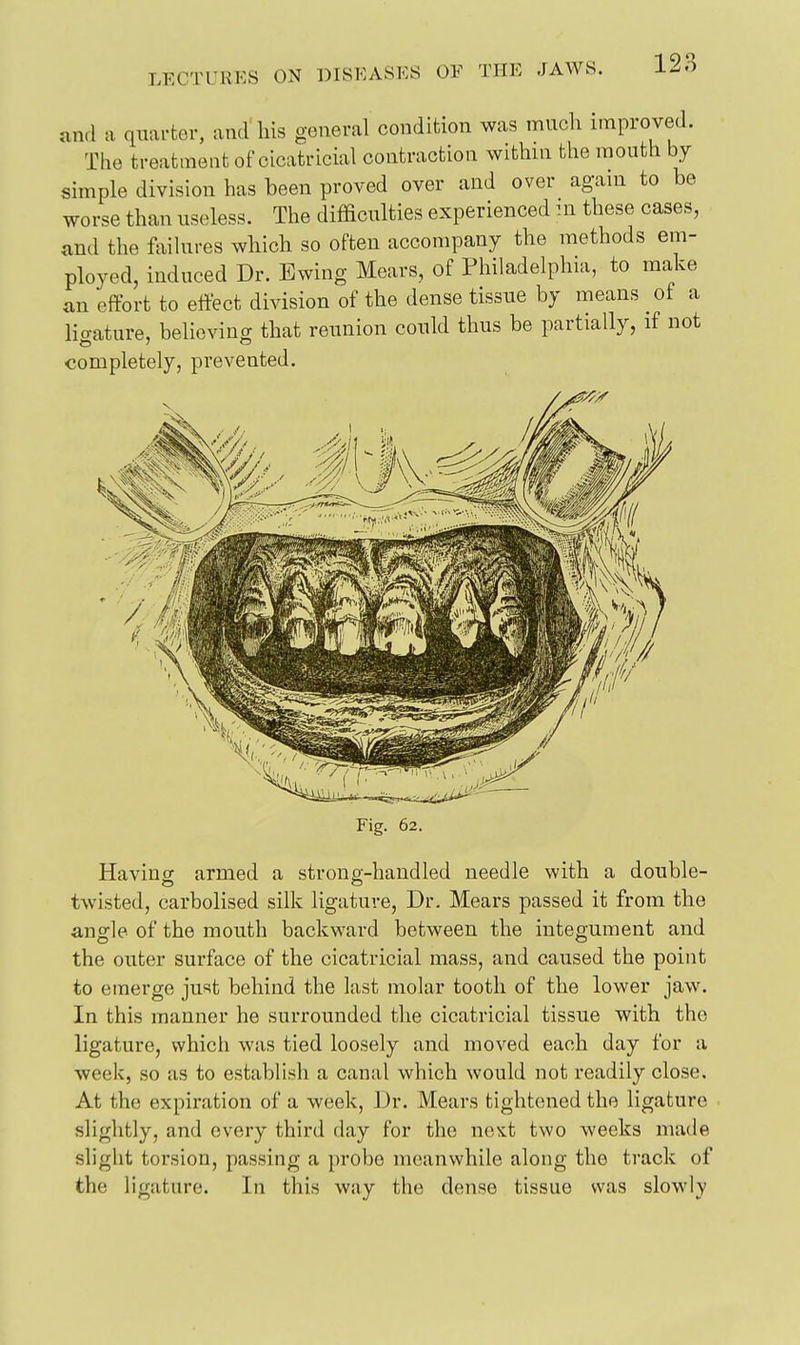 and a quarter, and liis general condition was much improved. The treatment of cicatricial contraction within the mouth by simple division has been proved over and over agam to be worse than useless. The difficulties experienced :n these cases, and the failures wliich so often accompany the methods em- ployed, induced Dr. Ewing Mears, of Philadelphia, to make an effort to effect division of the dense tissue by means of a liaature, believing that reunion could thus be partially, if not completely, prevented. Fig. 62. Having armed a strong-handled needle with a double- twisted, carbolised silk ligature, Dr. Mears passed it from the angle of the mouth backward between the integument and the outer surface of the cicatricial mass, and caused the point to emerge just behind the last molar tooth of the lower jaw. In this manner he surrounded the cicatricial tissue with the ligature, which was tied loosely and moved each day for a week, so as to establish a canal which would not readily close. At the expiration of a week. Dr. Mears tightened the ligature slightly, and every third day for the next two weeks made slight torsion, passing a probe meanwhile along the track of the ligature. In this way the dense tissue was slowly