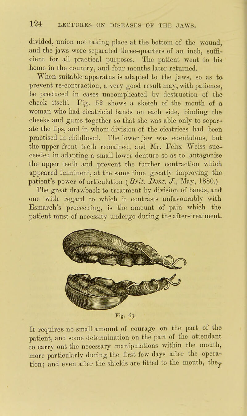 divided, union not taking pla,ce at the bottom of the wound, and the jaws were separated three-quarters of an inch, suffi- cient for all practical purposes. The patient went to his home in the country, and four months later returned. When suitable apparatus is adapted to the jaws, so as to prevent re-contraction, a very good result may, with patience, be produced in cases uncomplicated by destruction of the cheek itself. Fig, 62 shows a sketch of the mouth of a woman who had cicatricial bands on each side, binding the cheeks and gums together so that she was able only to separ- ate the lips, and in whom division of the cicatrices had been practised in childhood. The lower jaw was edentulous, but the upper front teeth remained, and Mr. Felix Weiss suc- ceeded in adapting a small lower denture so as to antagonise the upper teeth and prevent the further contraction which appeared imminent, at the same time greatly improving the patient's power of articulation ( Brit. Dent, t/., May, 1880.) The great drawback to treatment by division of bands, and one with regard to which it contrasts unfavourably with Esmarch's proceeding, is the amount of pain which the patient must of necessity undergo during the after-treatment. Fig. 63. It requires no small amount of courage on the part of the patient, and some determination on the part of the attendant to carry out the necessary manipulations wdthin the mouth, more particularly during the first few days after the opera- tion; and even after the shields arc fitted to the mouth, they