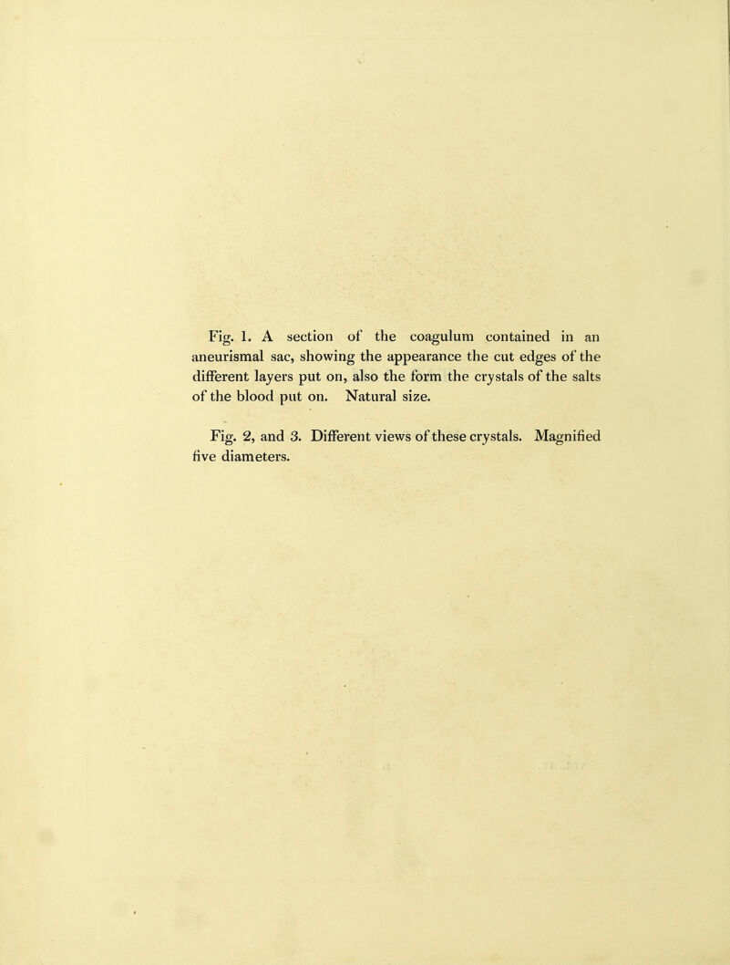 Fig. 1. A section of the coagulum contained in an aneurismal sac, showing the appearance the cut edges of the different layers put on, also the form the crystals of the salts of the blood put on. Natural size. Fig. 2, and 3. Different views of these crystals. Magnified five diameters.