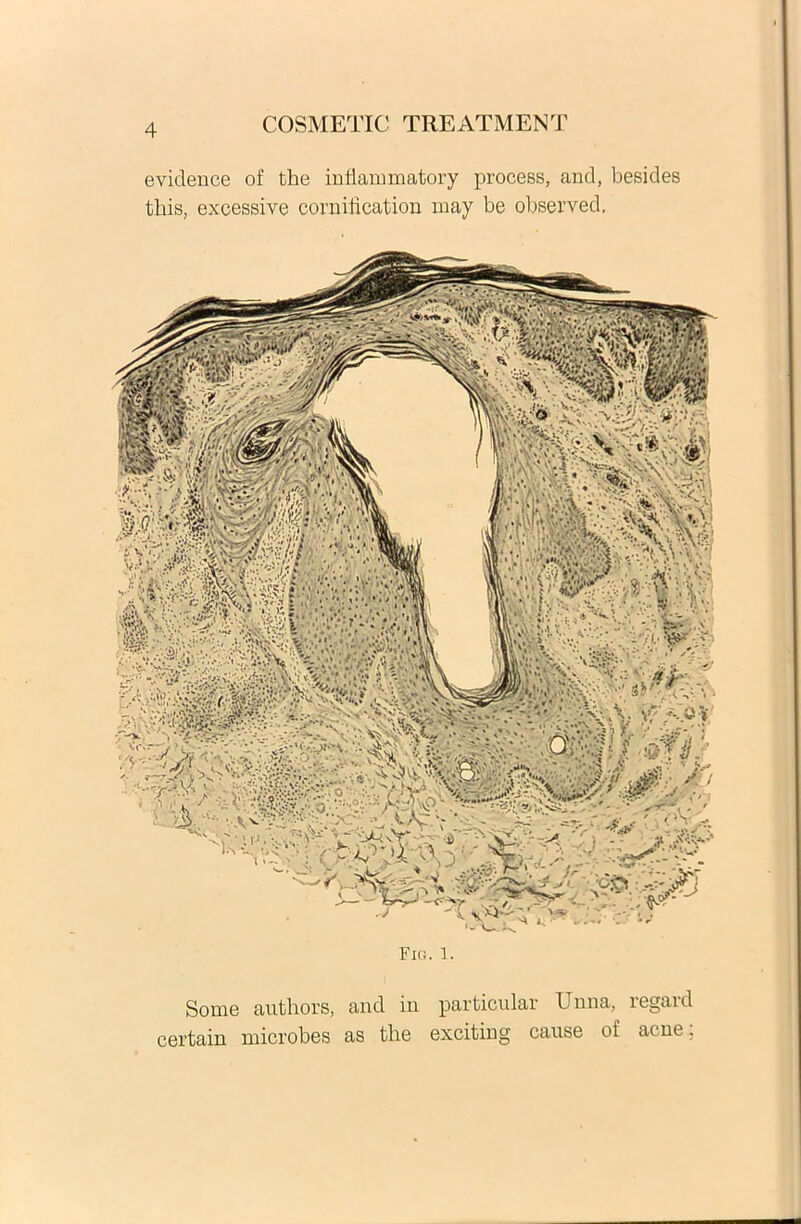 evidence of the inflammatory process, and, besides this, excessive cornification may be observed. Fig. i. Some authors, and in particular Unna, regard certain microbes as the exciting cause oi’ acne,