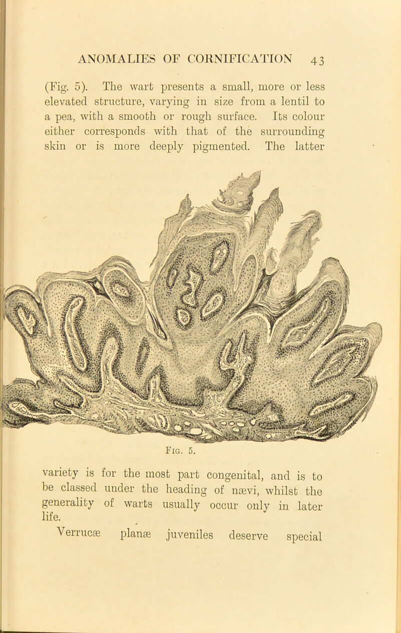 (Fig. 5). The wart presents a small, more or less elevated structure, varying in size from a lentil to a pea, with a smooth or rough surface. Its colour either corresponds with that of the surrounding skin or is more deeply pigmented. The latter Fig. 5. variety is for the most part congeuital, and is to be classed under the heading of naevi, whilst the generality of warts usually occur only in later life. Verrucae planae juveniles deserve special k