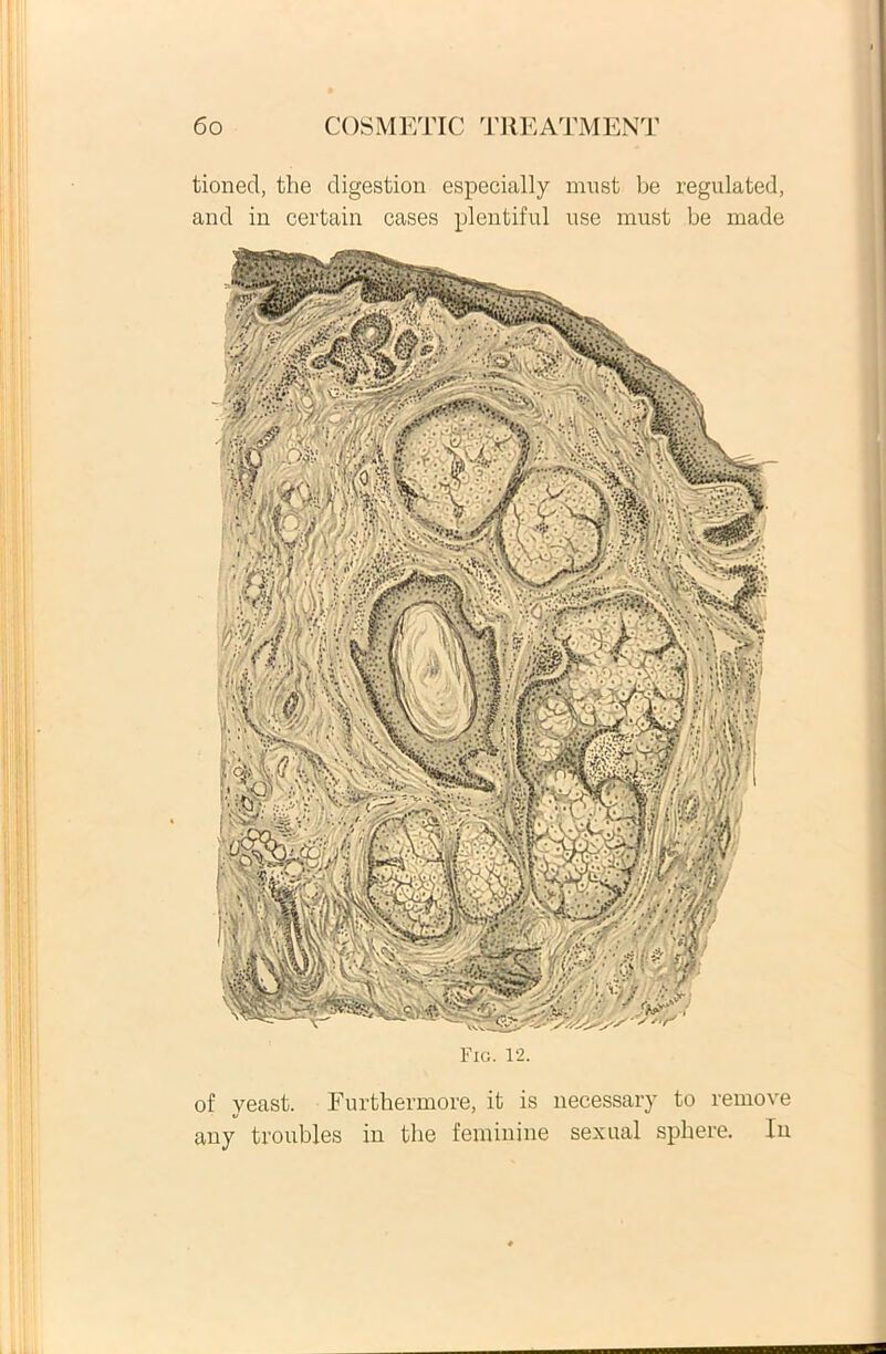 tioned, the digestion especially mu st be regulated, and in certain cases plentiful use must be made Fig. 12. of yeast. Furthermore, it is necessary to remove any troubles in the feminine sexual sphere. In