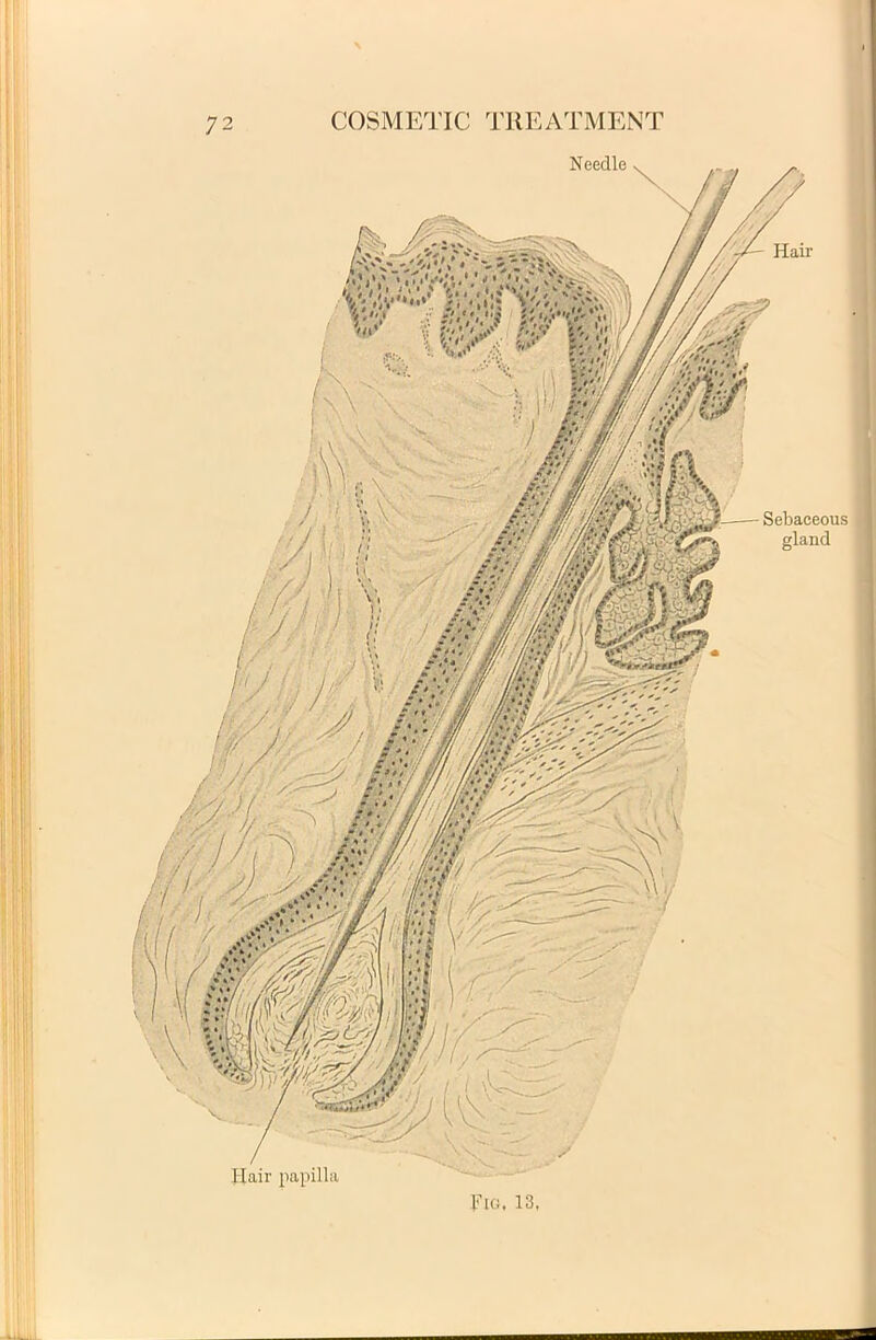 '. v . COSMETIC TIIEATMENT Needle Sebaceous gland Idair papilla Fio. 13,