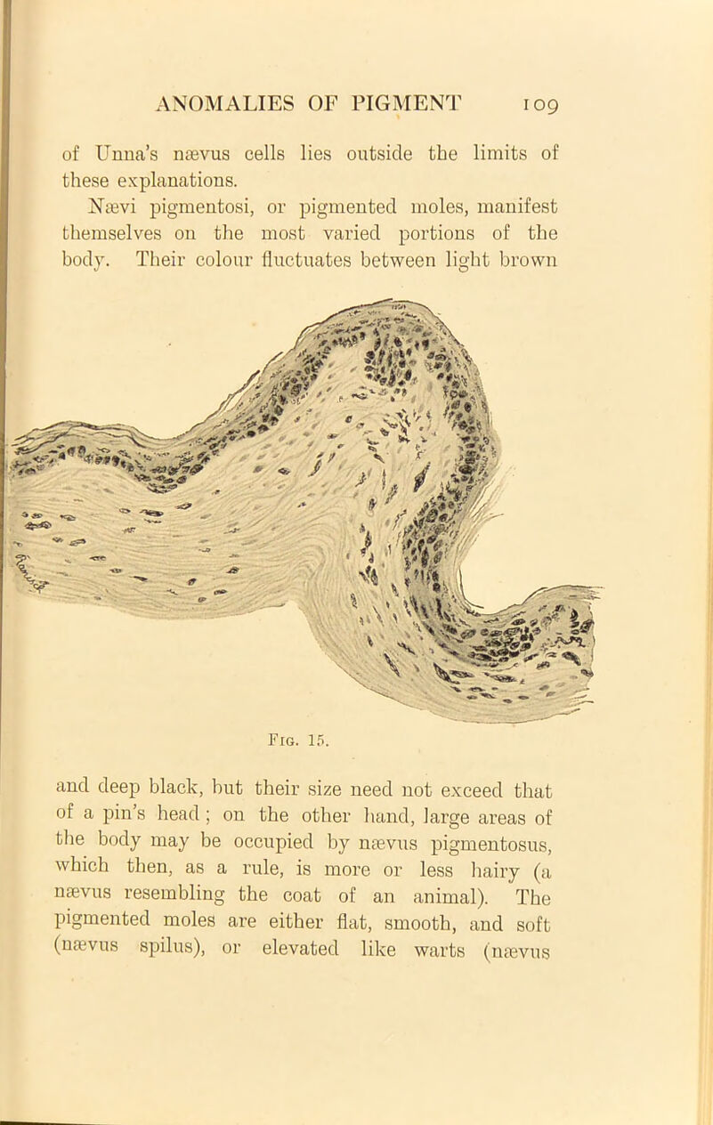of Unna’s naevus cells lies outside tbe limits of and deep black, but their size need not exceed that of a pin’s head; on tbe other hand, large areas of tbe body may be occupied by naevus pigmentosus, wbicb then, as a rule, is more or less hairy (a naevus resembling the coat of an animal). The pigmented moles are either flat, smootb, and soft (naevus spilus), or elevated like warts (naevus