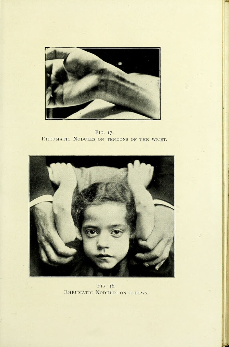 Fig. 17. Rheumatic Nodules on tendons of the wrist. Fig. 18. Rheumatic Nodules on elbows.