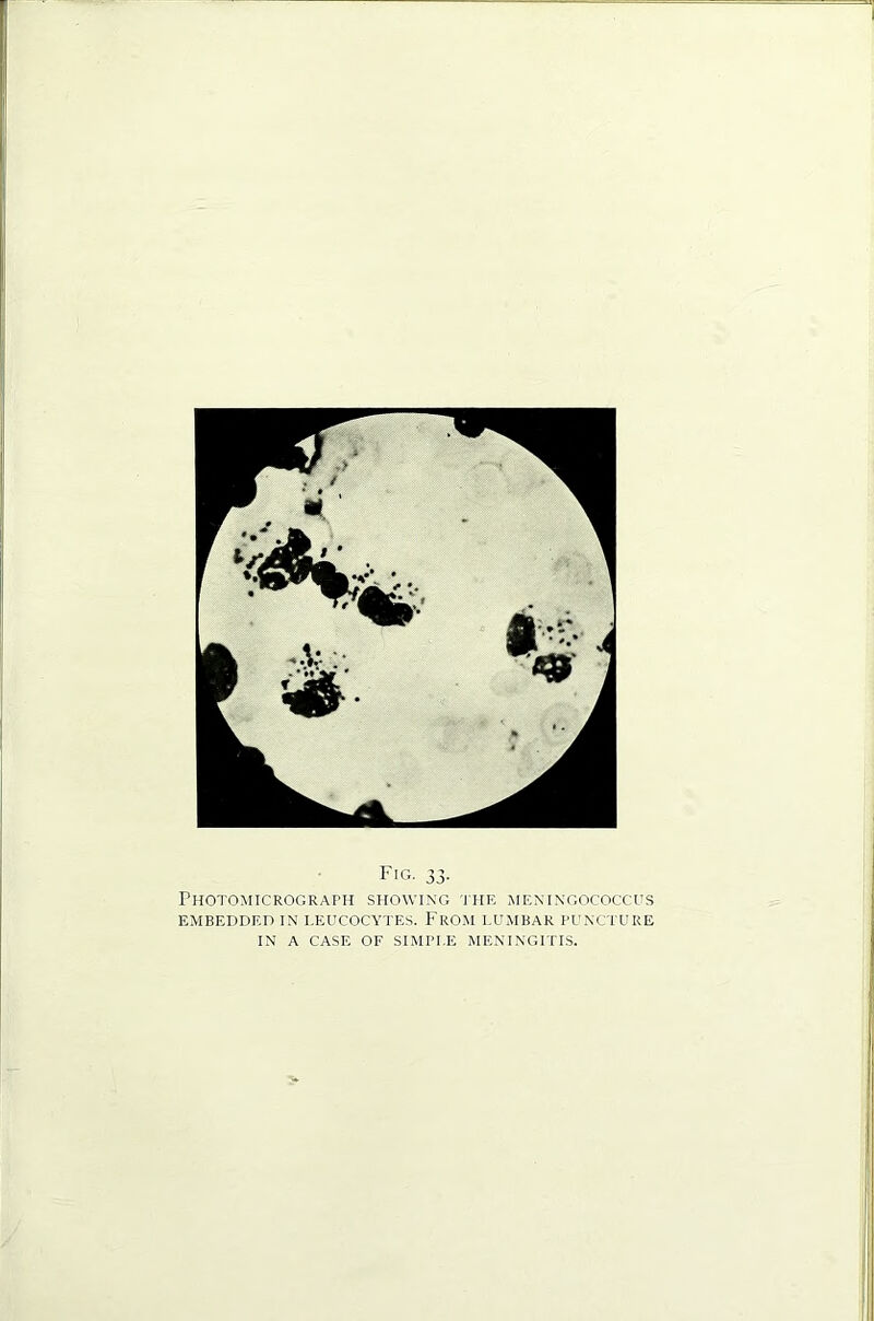 Fig. 33- PHOTOMICROGRArH SHOWING 'IHE MENINGOCOCCUS EMBEDDED IN LEUCOCYTES. FROM LUMBAR I'UNCTURE IN A CASE OF SIMPLE MENINGITIS.