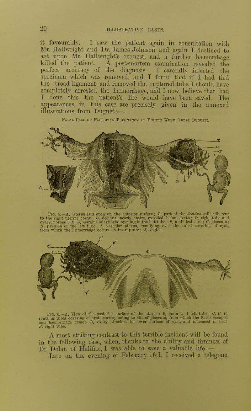 it favourably. I saw the patient again in consultation with Mr. Hallwright and Dr. James Johnson and again I declined to act upon Mr. Hallwright's request, and a further haemorrhage killed the patient. A post-mortem examination revealed the perfect accuracy of the diagnosis. I carefully injected the specimen which was removed, and I found that if I had tied the broad ligament and removed the ruptured tube I should have completely arrested the haemorrhage, and I now believe that had I done this the patient's life would have been saved. The appearances in this case are precisely given in the annexed illustrations from Duguet:— Fatal Case of Fallopian Pregnancy at Eighth Week (after Duguet). Fro. 6. A, View of the posterior surface of the uterus ; S, fimbria1, of left tube; C, C, C, rents in tubal covering of cyst, corresponding to site of placenta, from which the foetus escaped and hremorrhago came; D, ovary attached to lower surface of cyst, and increased in size: E, right tube. A most striking contrast to this terrible incident will be found in the following case, when, thanks to the ability and firmness of Dr. Dolan of Halifax, I was able to save a valuable life:— Late on the evening of February 16th I received a telegram