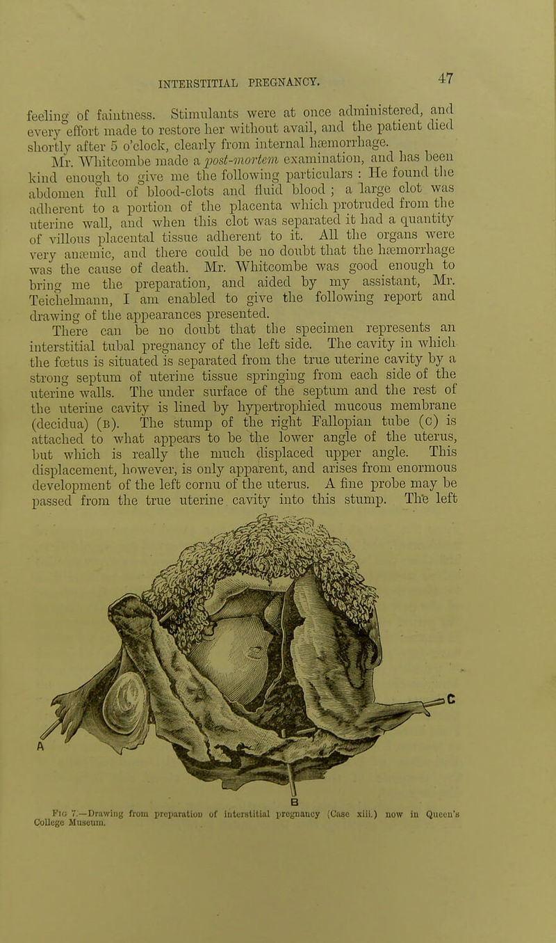 INTERSTITIAL PREGNANCY. feeling of faintness. Stimulants were at once administered, and every effort made to restore her without avail, and the patient died shortly after 5 o'clock, clearly from internal haemorrhage. Mr. Whitcombe made a, post-mortem examination, and has been kind enough to give me the following particulars : He found the abdomen Full of blood-clots and fluid blood ; a large clot was adherent to a portion of the placenta which protruded from the uterine wall, and when this clot was separated it had a quantity of villous placental tissue adherent to it. All the organs were very aiuvmic, and there could be no doubt that the hemorrhage was the cause of death. Mr. Whitcombe was good enough to bring me the preparation, and aided by my assistant, Mr. Teichelmann, I am enabled to give the following report and drawing of the appearances presented. There can be no doubt that the specimen represents an interstitial tubal pregnancy of the left side. The cavity in which the foetus is situated is separated from the true uterine cavity by a strong septum of uterine tissue springing from each side of the uterine walls. The under surface of the septum and the rest of the uterine cavity is lined by hypertrophied mucous membrane (decidna) (b). The stump of the right Fallopian tube (c) is attached to what appears to be the lower angle of the uterus, but which is really the much displaced upper angle. This displacement, however, is only apparent, and arises from enormous development of the left comu of the uterus. A fine probe may be passed from the true uterine cavity into this stump. Th'e left Flo 7.—Drawing from preparation of interstitial iirogiiaucy (Case xiii.) now iu Queen's College Museum.