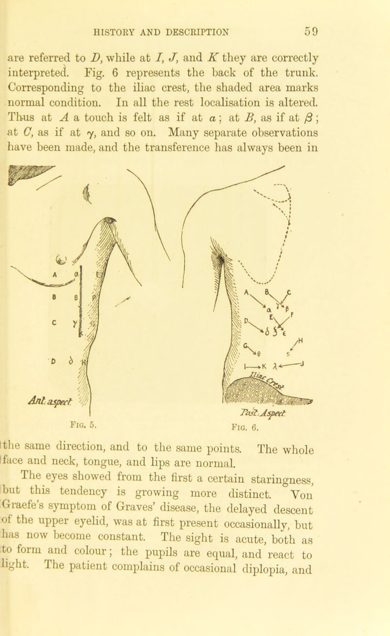 are referred to D, while at I, J, and K they are correctly interpreted. Fig. 6 represents the back of the trunk. Corresponding to the iliac crest, the shaded area marks normal condition. In all the rest localisation is altered. Thus at A a touch is felt as if at a; at B, as if at /3; at C, as if at 7, and so on. Many separate observations have been made, and the transference has always been in I the same direction, and to the same points. The whole I face and neck, tongue, and lips are normal. The eyes showed from the first a certain staringness, but this tendency is growing more distinct. Yon Graefe’s symptom of Graves’ disease, the delayed descent of the upper eyelid, was at first present occasionally, hut has now become constant. The sight is acute, both as to form and colour; the pupils are equal, and react to light. The patient complains of occasional diplopia, and