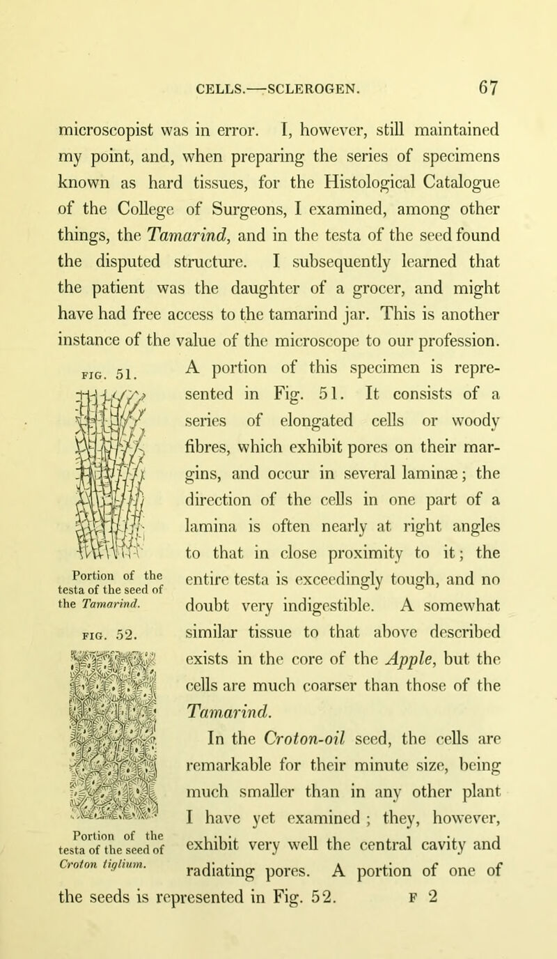 microscopist was in error. I, however, still maintained my point, and, when preparing the series of specimens known as hard tissues, for the Histological Catalogue of the College of Surgeons, I examined, among other things, the Tamarind, and in the testa of the seed found the disputed structure. I subsequently learned that the patient was the daughter of a grocer, and might have had free access to the tamarind jar. This is another instance of the value of the microscope to our profession. A portion of this specimen is repre- sented in Fig. 51. It consists of a series of elongated cells or woody fibres, which exhibit pores on their mar- gins, and occur in several laminae; the direction of the cells in one part of a lamina is often nearly at right angles to that in close proximity to it; the entire testa is exceedingly tough, and no doubt very indigestible. A somewhat similar tissue to that above described exists in the core of the Apple, but the cells are much coarser than those of the Tamarind. In the Croton-oil seed, the cells are remarkable for their minute size, being much smaller than in any other plant I have yet examined ; they, however, exhibit very well the central cavity and radiating pores. A portion of one of the seeds is represented in Fig. 52. f 2 FIG. 51. Portion of the testa of the seed of the Tamarind. FIG. 52. Portion of the testa of the seed of Croton tiglimn.