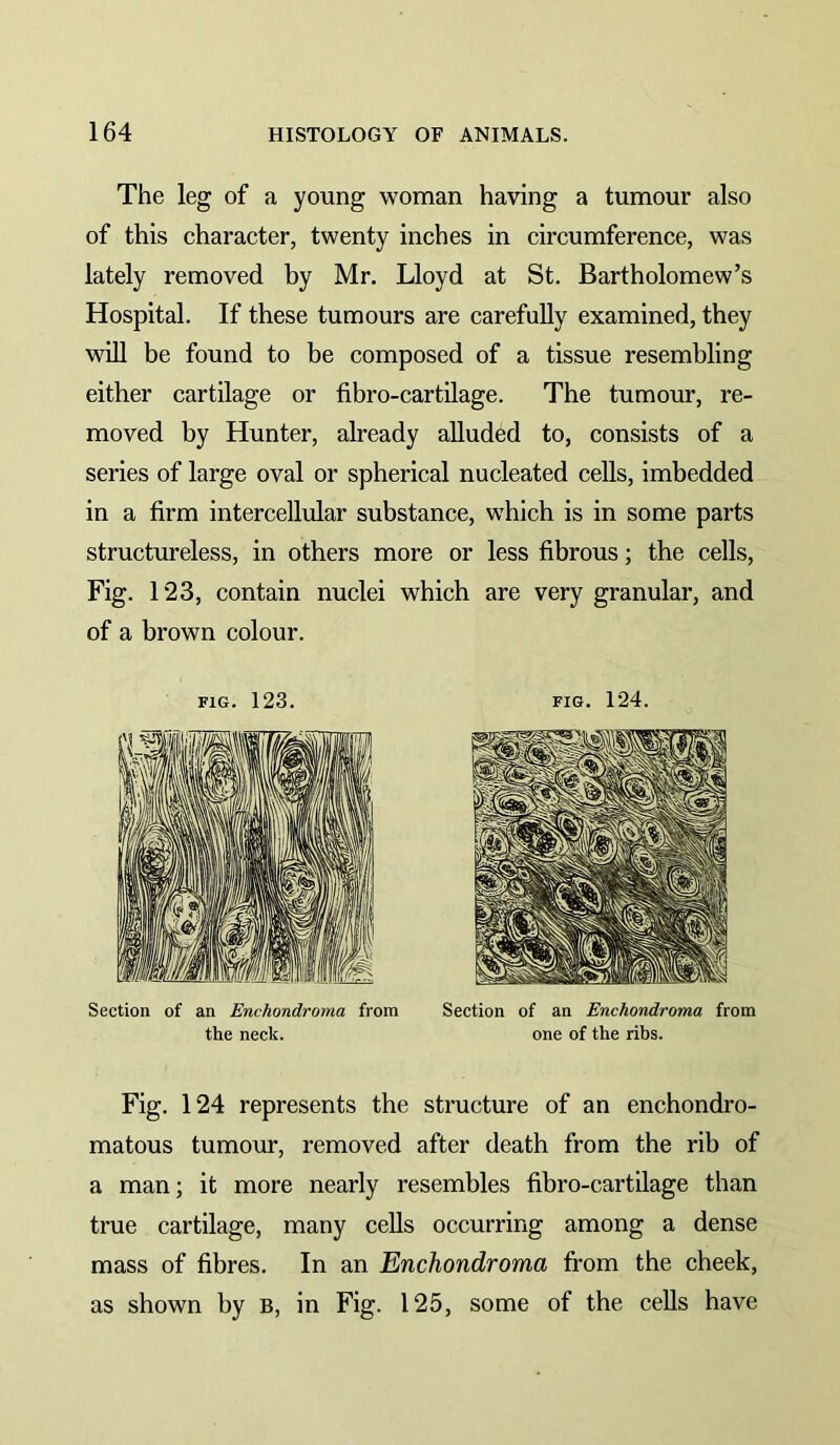 The leg of a young woman having a tumour also of this character, twenty inches in circumference, was lately removed by Mr. Lloyd at St. Bartholomew’s Hospital. If these tumours are carefully examined, they will be found to be composed of a tissue resembling either cartilage or fibro-cartilage. The tumour, re- moved by Hunter, already alluded to, consists of a series of large oval or spherical nucleated cells, imbedded in a firm intercellidar substance, which is in some parts structureless, in others more or less fibrous; the cells. Fig. 123, contain nuclei which are very granular, and of a brown colour. Fig. 124 represents the structure of an enchondro- matous tumour, removed after death from the rib of a man; it more nearly resembles fibro-cartilage than true cartilage, many cells occurring among a dense mass of fibres. In an Enchondroma from the cheek, as shown by b, in Fig. 125, some of the cells have