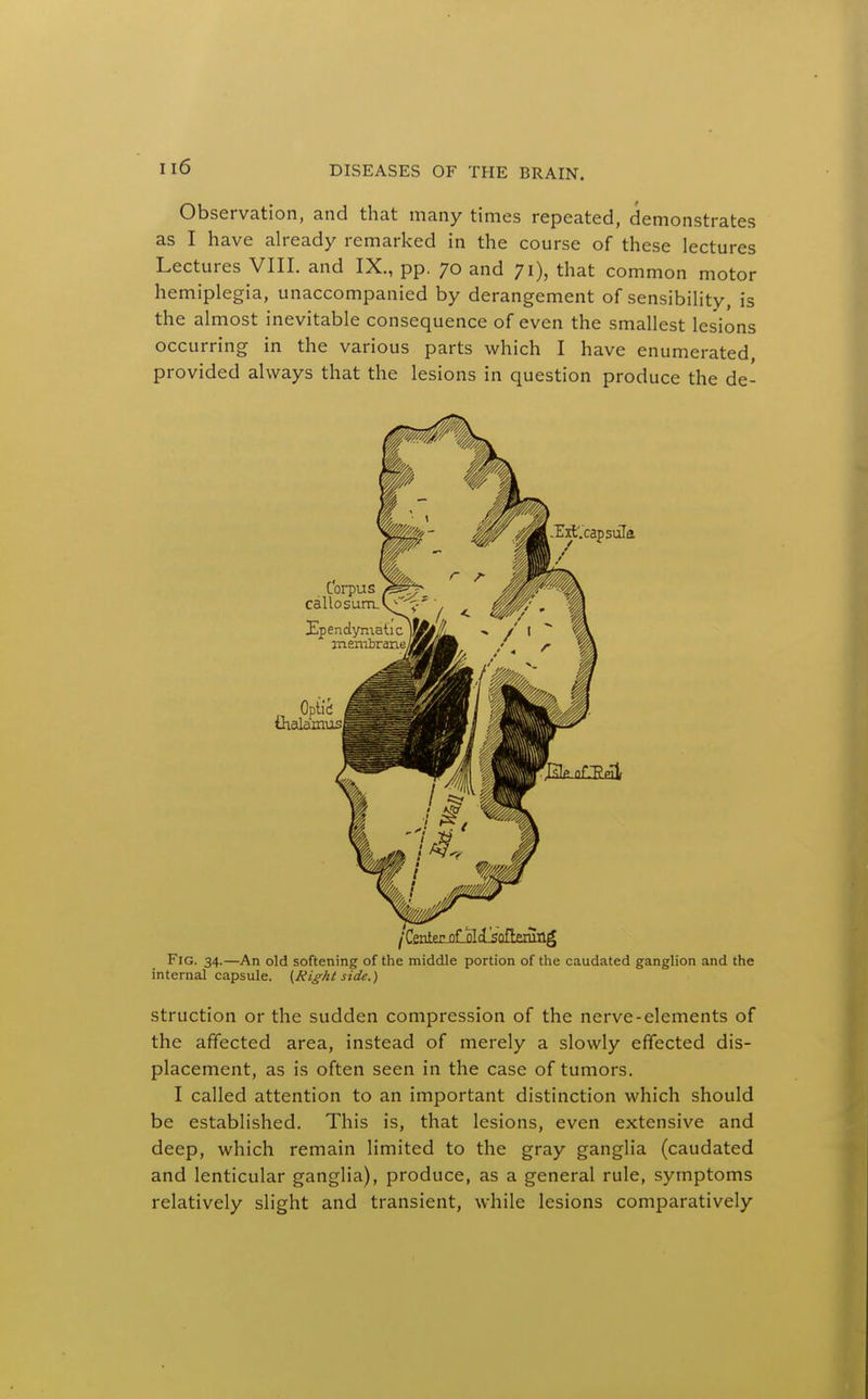 Observation, and that many times repeated, demonstrates as I have already remarked in the course of these lectures Lectures VIII. and IX., pp. 70 and ;i), that common motor hemiplegia, unaccompanied by derangement of sensibilitv, is the almost inevitable consequence of even the smallest lesions occurring in the various parts which I have enumerated, provided always that the lesions in question produce the de- FiG. 34.—An old softening of the middle portion of the caudated ganglion and the internal capsule. {^Right side.) struction or the sudden compression of the nerve-elements of the affected area, instead of merely a slowly effected dis- placement, as is often seen in the case of tumors. I called attention to an important distinction which should be established. This is, that lesions, even extensive and deep, which remain limited to the gray ganglia (caudated and lenticular ganglia), produce, as a general rule, symptoms relatively slight and transient, while lesions comparatively