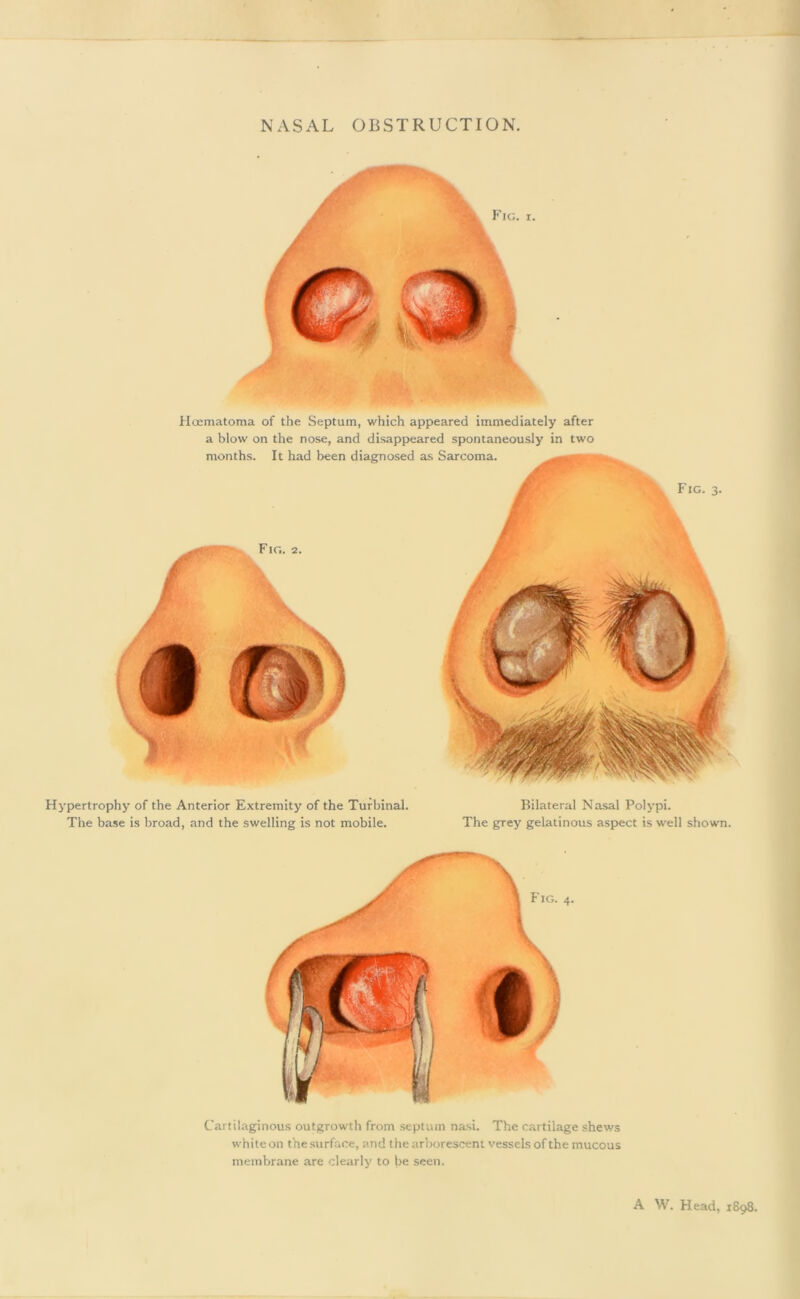 Fig. I. Hcematoma of the Septum, which appeared immediately after a blow on the nose, and disappeared spontaneously in two If nnrl Hionrnr»CAr? oc ^2Jrr*r\mo Hypertrophy of the Anterior Extremity of the Turbinal. Bilateral Nasal Polypi. The base is broad, and the swelling is not mobile. The grey gelatinous aspect is well shown. Cartilaginous outgrowth from septum nasi. The cartilage shews white on the surface, and the arborescent vessels of the mucous membrane are clearly to be seen. A W. Head, 1898.