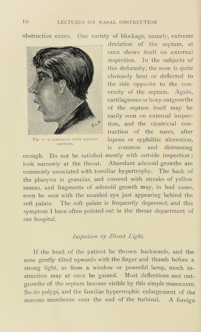 obstruction exists. One variety of blockage, namel>’, extreme deviation of the septum, at once shows itself on external inspection. In the subjects of this deformity, the nose is quite obviously bent or deflected to the side opposite to the con- vexity of the septum. Again, cartilaginous or bony outgrowths of the septum itself may be easily seen on external inspec- tion, and the cicatricial con- traction of the nares, after Fig. I.—A SCHOOLBOY WITH ADENOID lupous Or sypliiUtic ulceration, GROWTHS. is common and distressing enough. Do not be satisfied merely with outside inspection ; look narrowly at the throat. Abundant adenoid growths are commonly associated with tonsillar hypertrophy. The back of the pharynx is granular, and covered with streaks of yellow mucus, and fragments of adenoid growth may, in bad cases, even be seen with the unaided eye just appearing behind the soft palate. The soft palate is frequently depressed, and this symptom I have often pointed out in the throat department of our hospital. Inspection by Direct Light. If the head of the patient be thrown backwards, and the nose gently tilted upwards with the finger and thumb before a strong light, as from a window or powerful lamp, much in- struction may at once be gained. Most deflections and out- growths of the septum become visible by this simple manoeuvre. So do polypi, and the familiar hypertrophic enlargement of the mucous membrane over the end of the turbinal. A foreijjn O