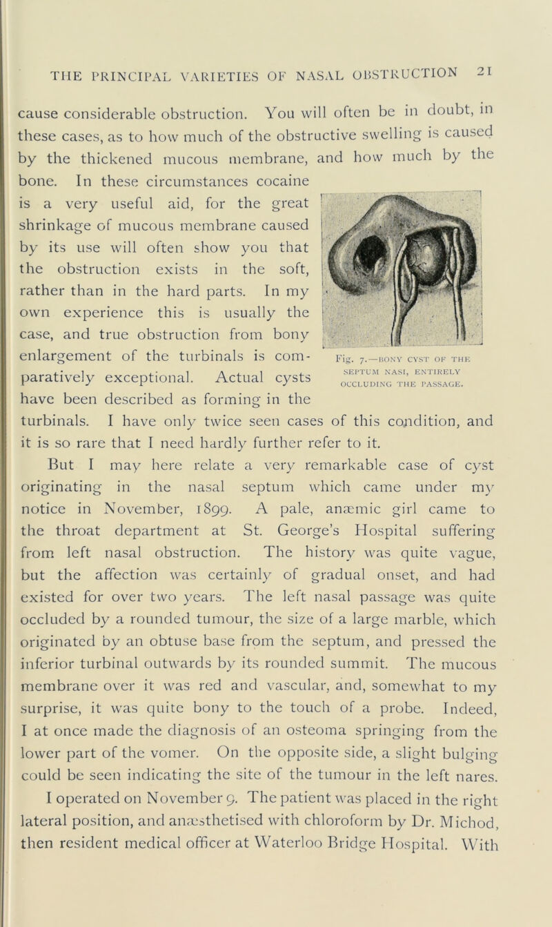 cause considerable obstruction. You will often be in doubt, in these cases, as to how much of the obstructive swelling is caused by the thickened mucous membrane, and how much by the bone. In these circumstances cocaine is a very useful aid, for the great shrinkage of mucous membrane caused by its use will often show you that the obstruction exists in the soft, rather than in the hard parts. In my own experience this is usually the case, and true obstruction from bony enlargement of the turbinals is com- paratively exceptional. Actual cysts have been described as forming in the turbinals. I have only twice seen cases of this condition, and it is so rare that I need hardly further refer to it. But I may here relate a very remarkable case of cyst originating in the nasal septum which came under my notice in November, 1899. A pale, anmmic girl came to the throat department at St. George’s Hospital suffering from left nasal obstruction. The history was quite vague, but the affection was certainly of gradual onset, and had existed for over two years. The left nasal passage was quite occluded by a rounded tumour, the size of a large marble, which originated by an obtuse base from the septum, and pressed the inferior turbinal outwards by its rounded summit. The mucous membrane over it was red and vascular, and, somewhat to my surprise, it was quite bony to the touch of a probe. Indeed, I at once made the diagnosis of an osteoma springing from the lower part of the vomer. On the opposite side, a slight bulging could be seen indicating the site of the tumour in the left nares. I operated on November 9. The patient was placed in the right lateral position, and anaesthetised with chloroform by Dr. Michod, then resident medical officer at Waterloo Bridge Hospital. With