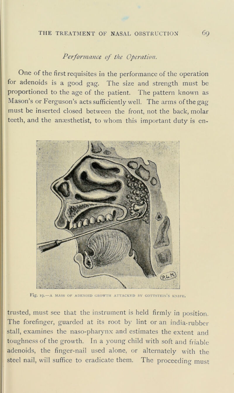 Performance of the Operation. One of the first requisites in the performance of the operation for adenoids is a good gag. The size and strength must be proportioned to the age of the patient. The pattern known as Mason’s or Ferguson’s acts sufficiently well. The arms of the gag must be inserted closed between the front, not the back, molar teeth, and the anaesthetist, to whom this important duty is en- trusted, must see that the instrument is held firmly in position. The forefinger, guarded at its root by lint or an india-rubber stall, examines the naso-pharynx and estimates the extent and toughness of the growth. In a young child with soft and friable adenoids, the finger-nail used alone, or alternately with the steel nail, will suffice to eradicate them. The proceeding must
