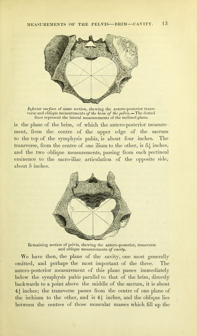 Inferior surface of same section, shewing the antero-posterior trans- verse and oblique measurements of the brim of the pelvis.—The dotted lines represent the lateral measurements of the inclined plane. is the plane of the brim, of which the antero-posterior measure- ment, from the centre of the upper edge of the sacrum to the top of the symphysis pubis, is about four inches. The transverse, from the centre of one ilium to the other, is 5-| inches, and the two oblique measurements, passing from each pectineal eminence to the sacro-iliac articulation of the opposite side, about 5 inches. Remaining section of pelvis, shewing the antero-posterior, transverse and oblique measurements of cavity. We have then, the plane of the cavity, one most generally omitted, and perhaps the most important of the three. The antero-posterior measurement of this plane passes immediately below the symphysis pubis parallel to that of the brim, directly backwards to a point above the middle of the sacrum, it is about 4f inches; the transverse passes from the centre of one plane of the ischium to the other, and is 45 inches, and the oblique lies between the centres of those muscular masses which fill up the