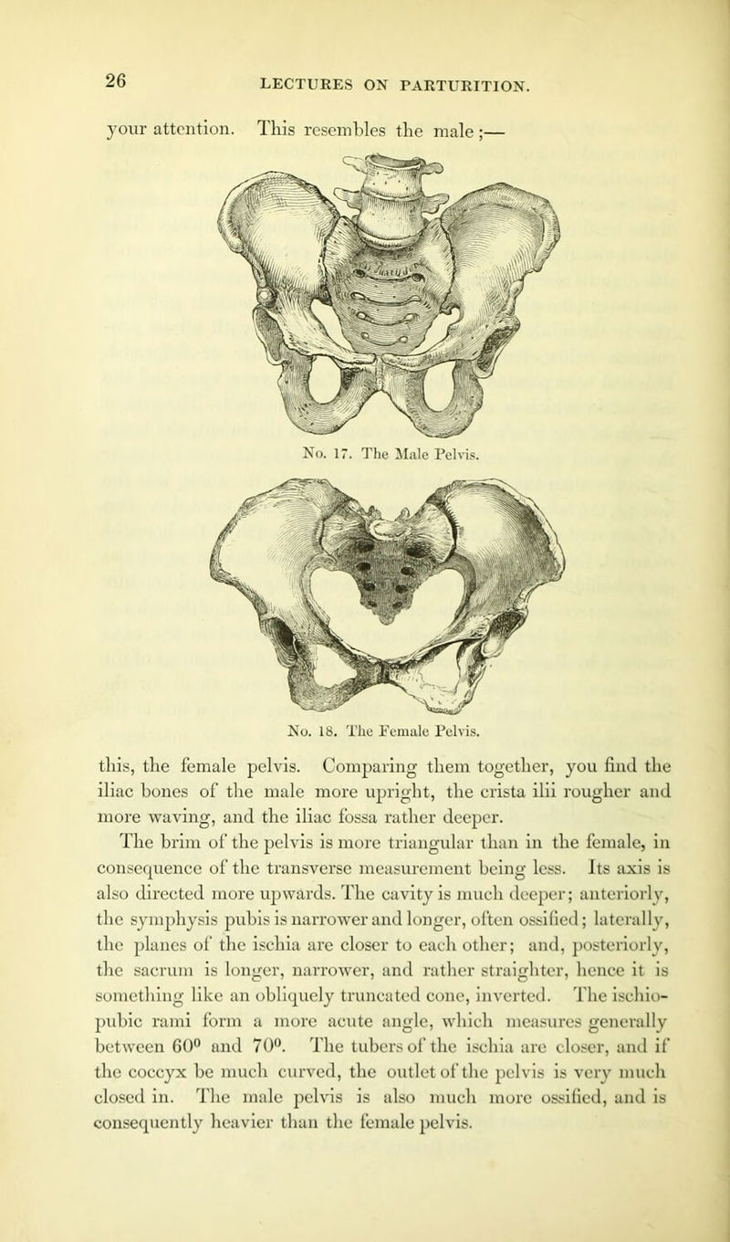 your attention. This resembles the male ;— No. 17. The Male Pelvis. No. 18. The Female Pelvis. this, the female pelvis. Comparing them together, you find the iliac bones of the male more upright, the crista ilii rougher and more waving, and the iliac fossa rather deeper. The brim of the pelvis is more triangular than in the female, in consequence of the transverse measurement being less. Its axis is also directed more upwards. The cavity is much deeper; anteriorly, the symphysis pubis is narrower and longer, often ossified; laterally, the planes of the ischia are closer to each other; and, posteriorly, the sacrum is longer, narrower, and rather straighter, hence it is something like an obliquely truncated cone, inverted. The ischio- pubic rami form a more acute angle, which measures generally between 60° and 70°. The tubers of the ischia are closer, and if the coccyx be much curved, the outlet of the pelvis is very much closed in. The male pelvis is also much more ossified, and is consequently heavier than the female pelvis.