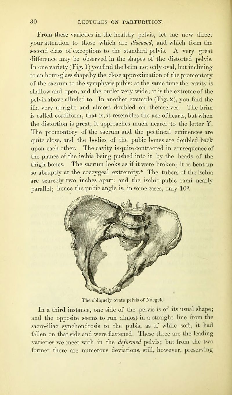From these varieties in the healthy pelvis, let me now direct your attention to those which are diseased, and which form the second class of exceptions to the standard pelvis. A very great difference may he observed in the shapes of the distorted pelvis. In one variety (Fig. 1) youfind the brim not only oval, but inclining to an hour-glass shape by the close approximation of the promontory of the sacrum to the symphysis pubis: at the same time the cavity is shallow and open, and the outlet very wide; it is the extreme of the pelvis above alluded to. In another example (Fig. 2), you find the ilia very upright and almost doubled on themselves. The brim is called cordiform, that is, it resembles the ace of hearts, but when the distortion is great, it approaches much nearer to the letter Y. The promontory of the sacrum and the pectineal eminences are quite close, and the bodies of the pubic bones are doubled back upon each other. The cavity is quite contracted in consequence of the planes of the ischia being pushed into it by the heads of the thigh-bones. The sacrum looks as if it were broken; it is bent un so abruptly at the coccygeal extremity.* The tubers of the ischia are scarcely two inches apart; and the iscliio-pubic rami nearly parallel; hence the pubic angle is, in some cases, only 10°. The obliquely ovate pelvis of Naegele. In a third instance, one side of the pelvis is of its usual shape; and the opposite seems to run almost in a straight fine from the sacro-iliac synchondrosis to the pubis, as if while soft, it had fallen on that side and were flattened. These three are the leading varieties we meet with in the deformed pelvis; but from the two former there are numerous deviations, still, however, preserving